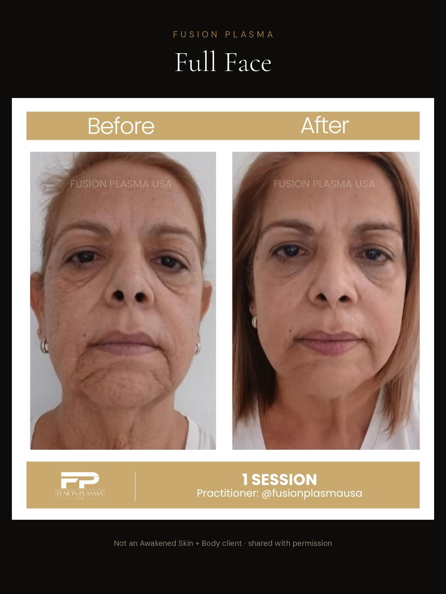 Full Face before and after, Fusion Plasma, result by a certified practitioner outside our studio