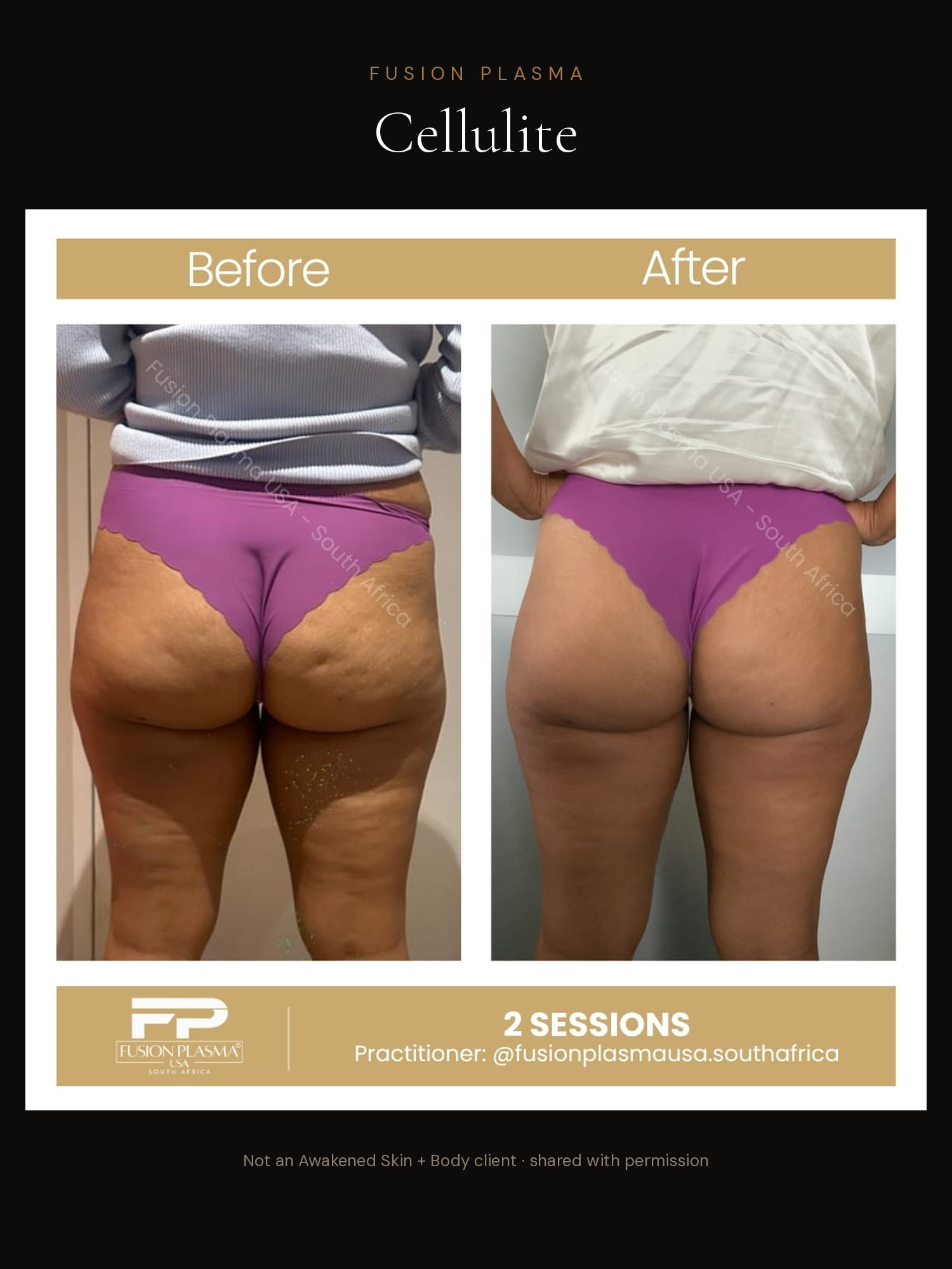Cellulite before and after, Fusion Plasma, result by a certified practitioner outside our studio