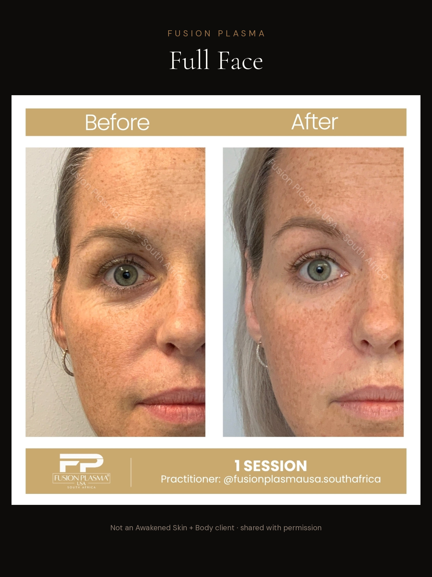 Full Face before and after, Fusion Plasma, result by a certified practitioner outside our studio