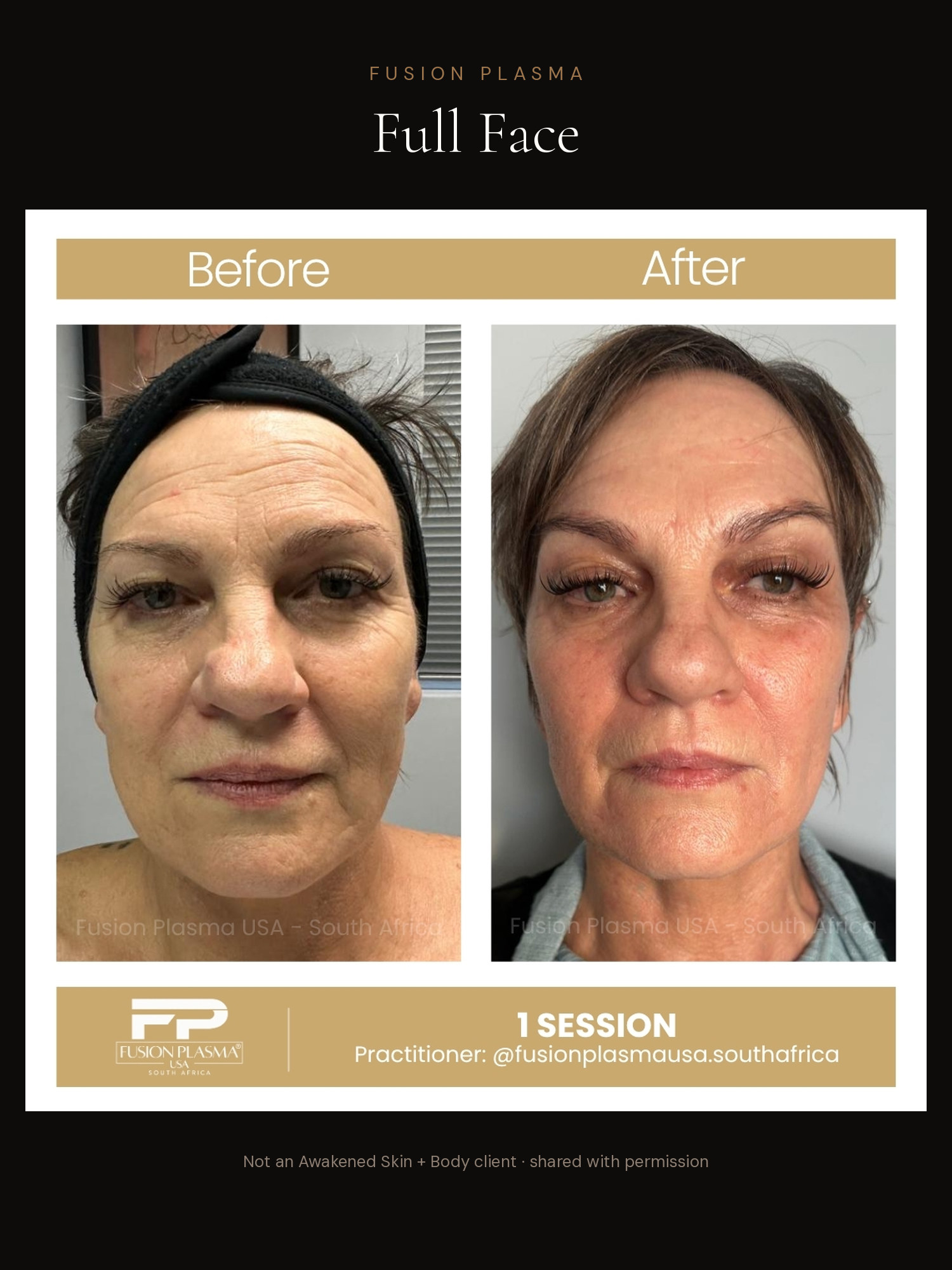 Full Face before and after, Fusion Plasma, result by a certified practitioner outside our studio