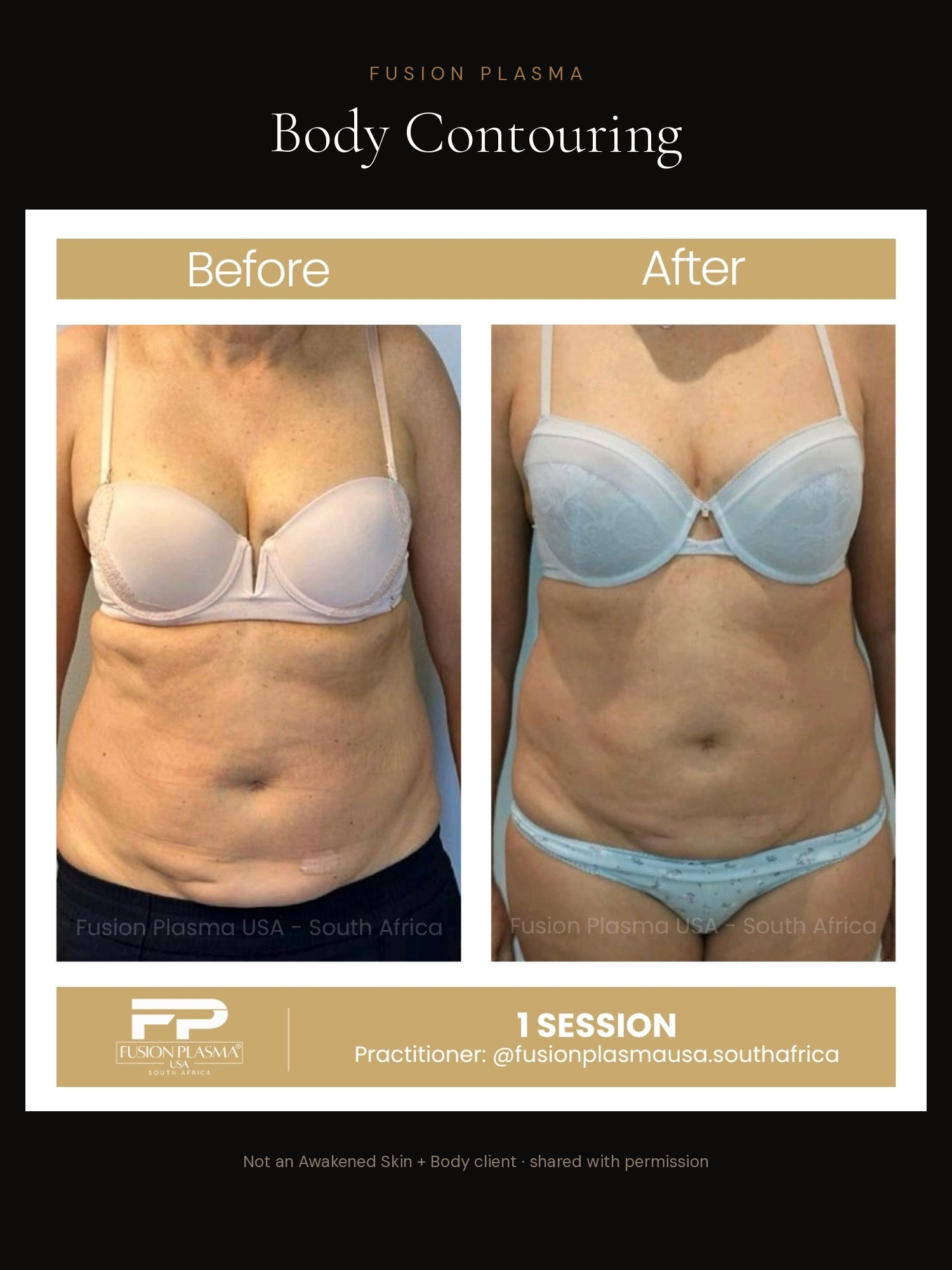 Body Contouring before and after, Fusion Plasma, result by a certified practitioner outside our studio