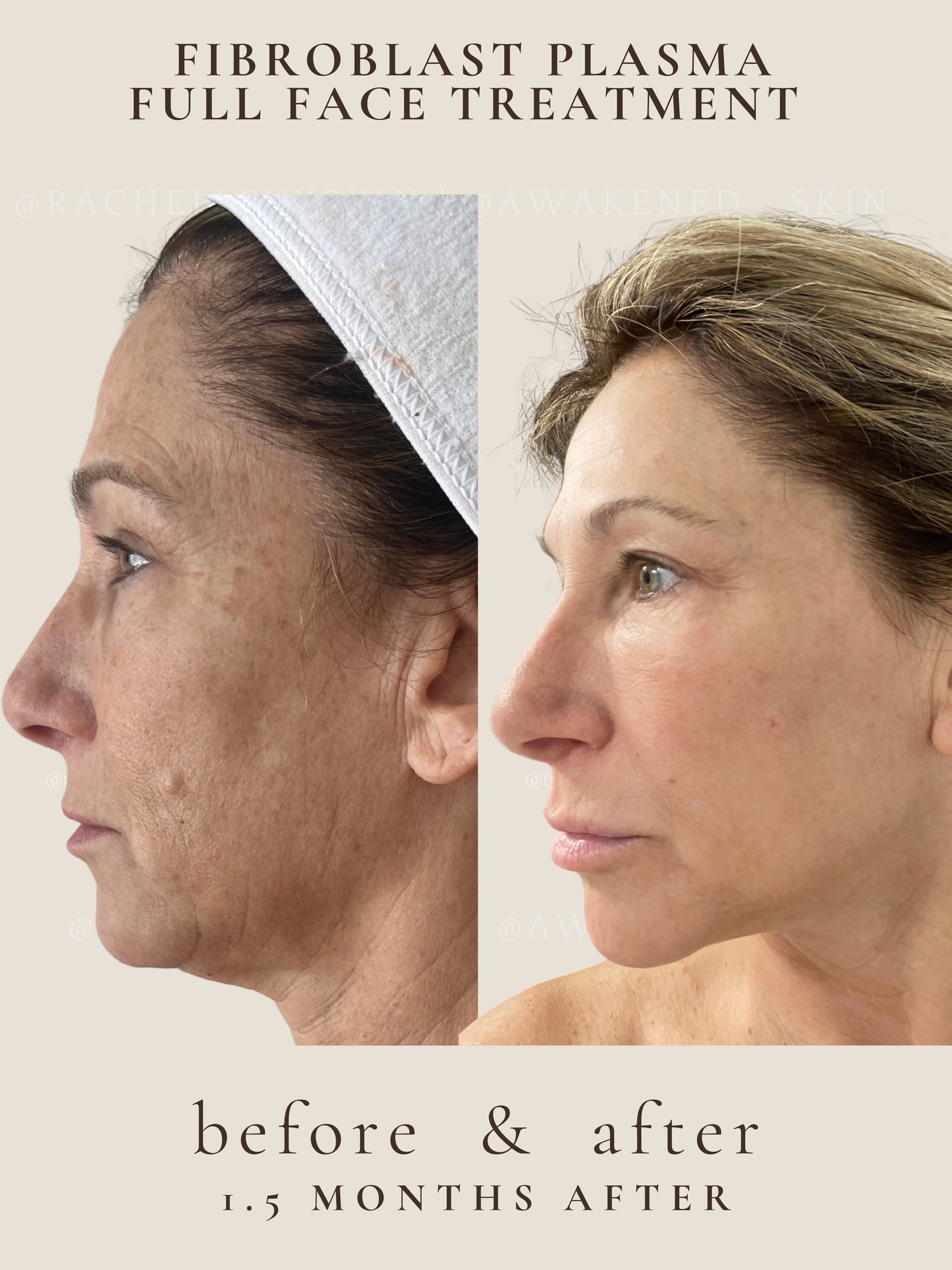 Fibroblast result