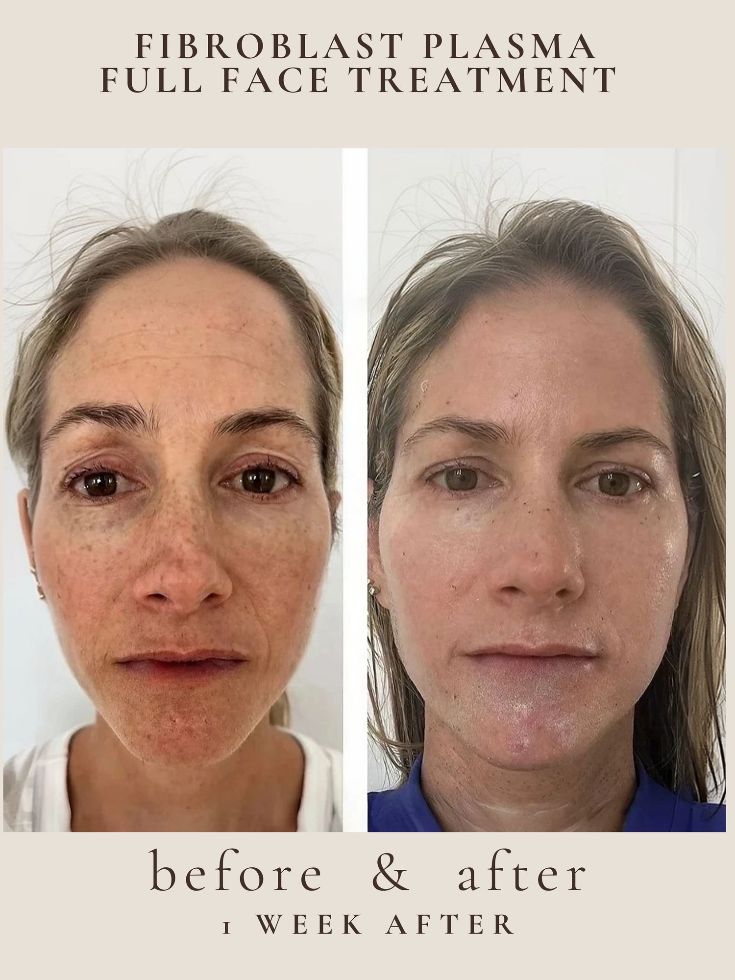 Facial rejuvenation before and after