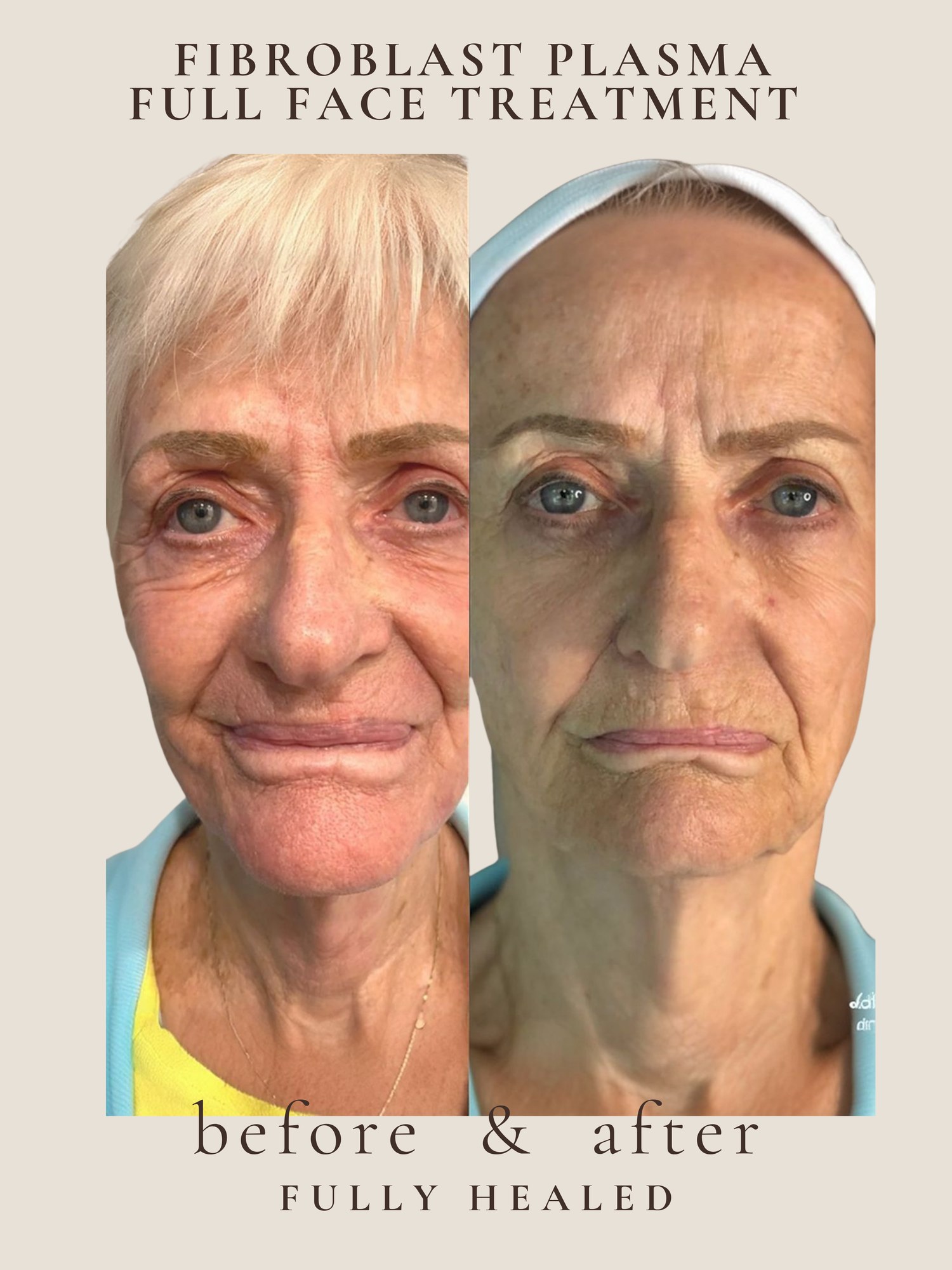 Full Face — Fibroblast Plasma