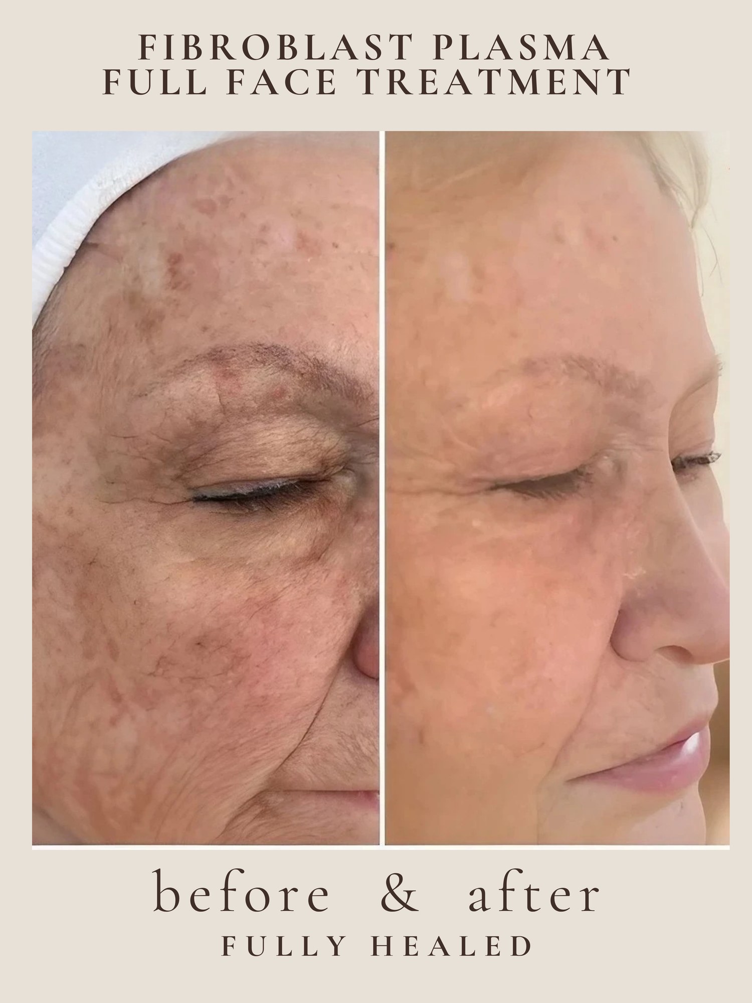 Full Face — Fibroblast Plasma