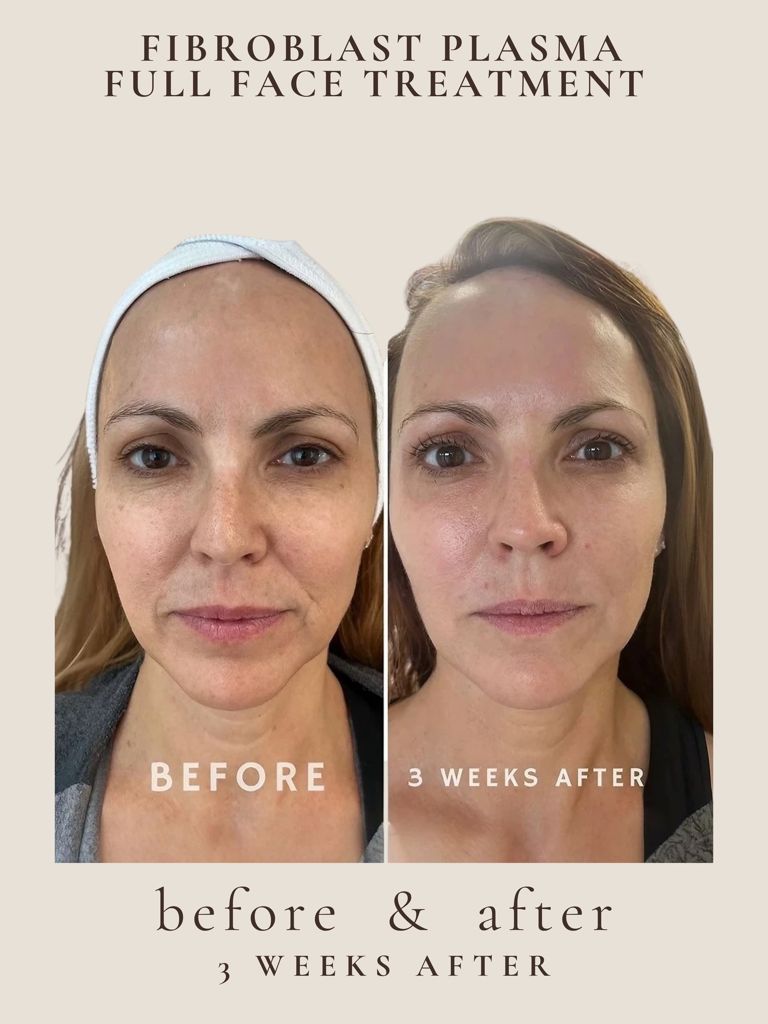 Full Face — Fibroblast Plasma
