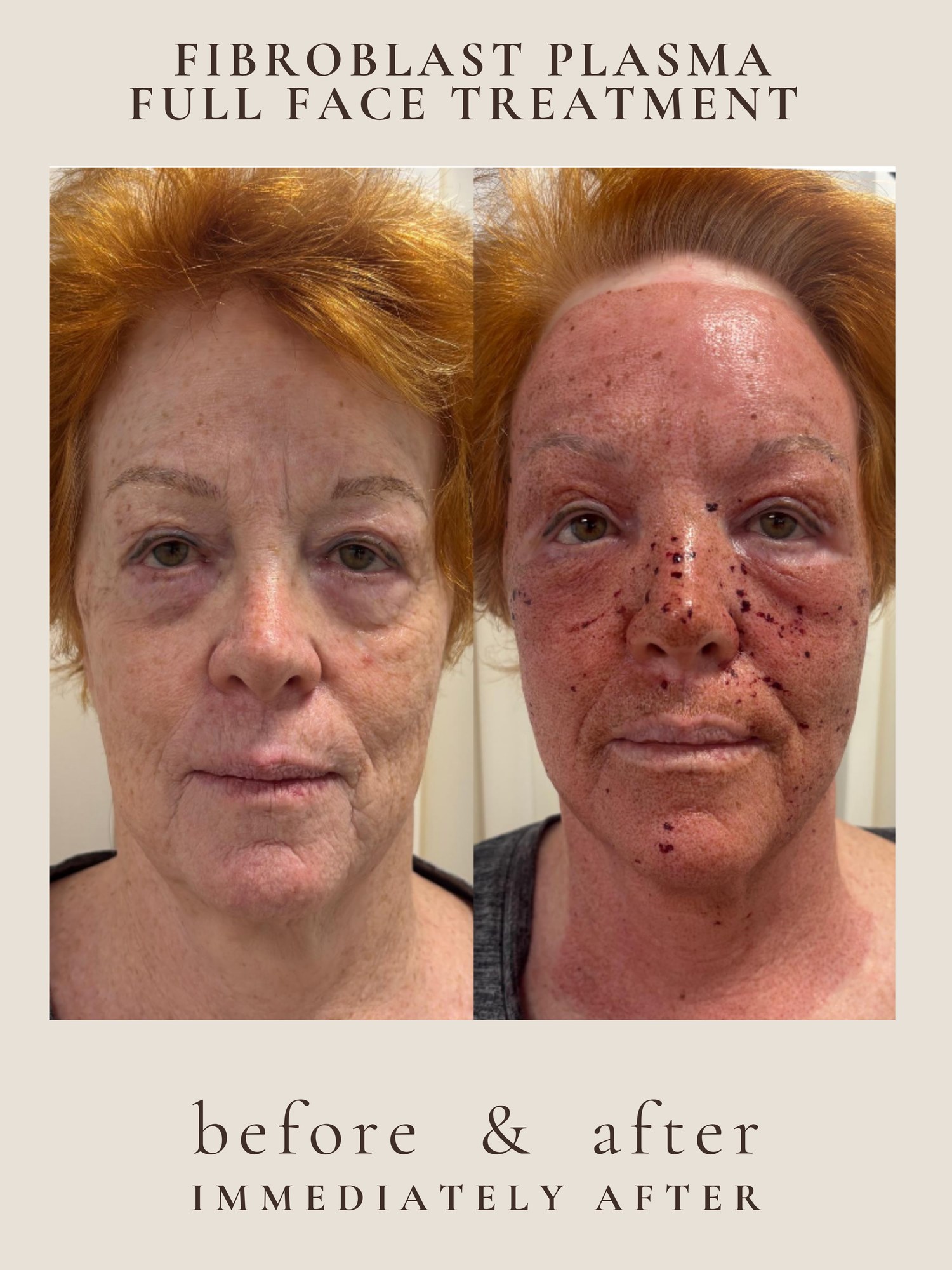 Full Face — Fibroblast Plasma