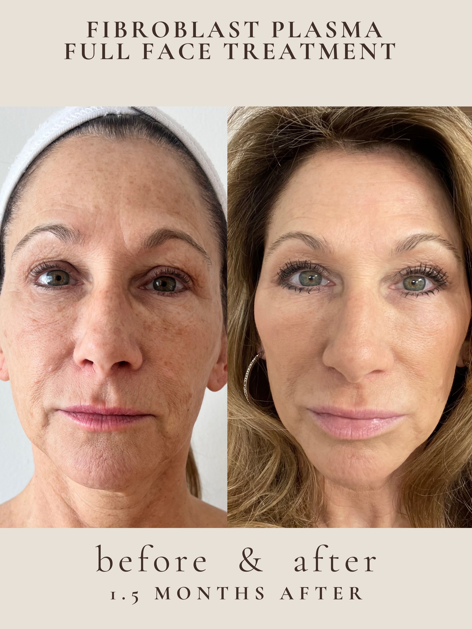 Full Face — Fibroblast Plasma