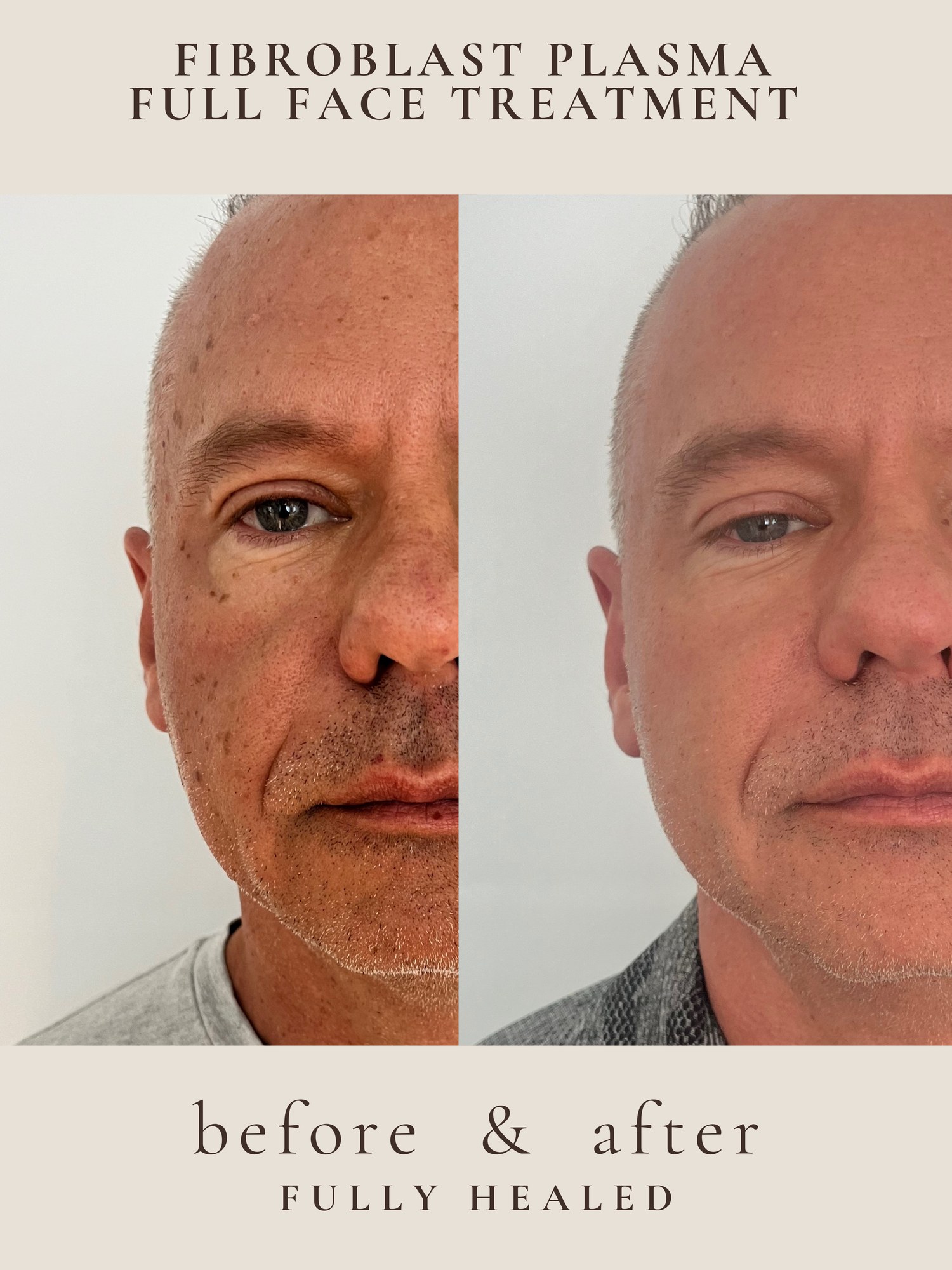 Full Face — Fibroblast Plasma