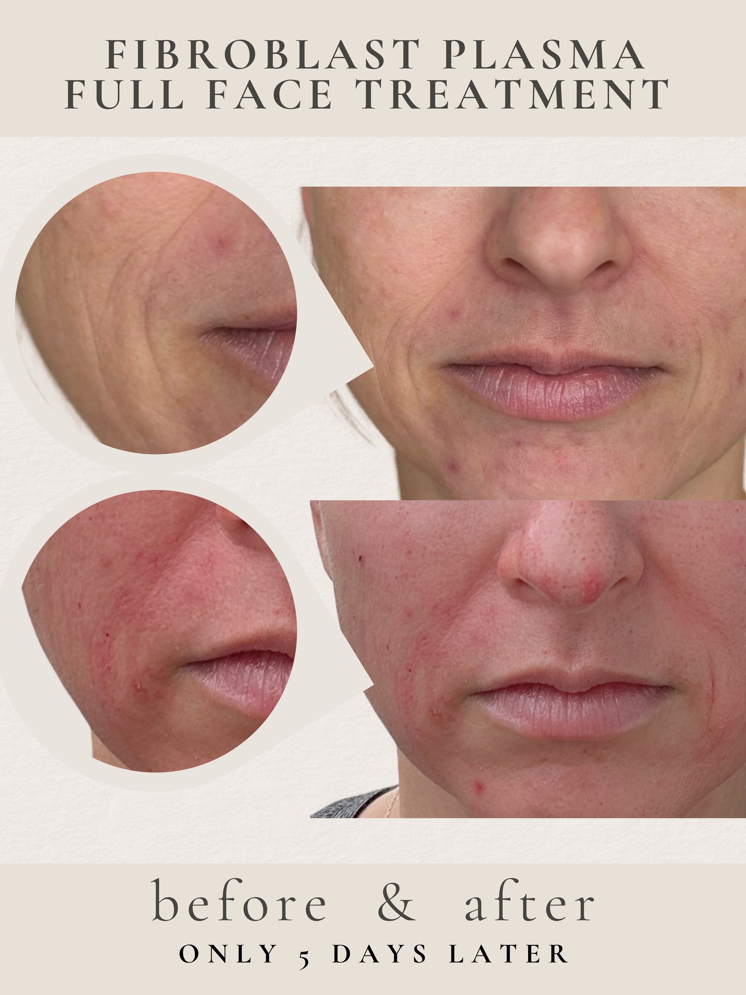 Full Face — Fibroblast Plasma