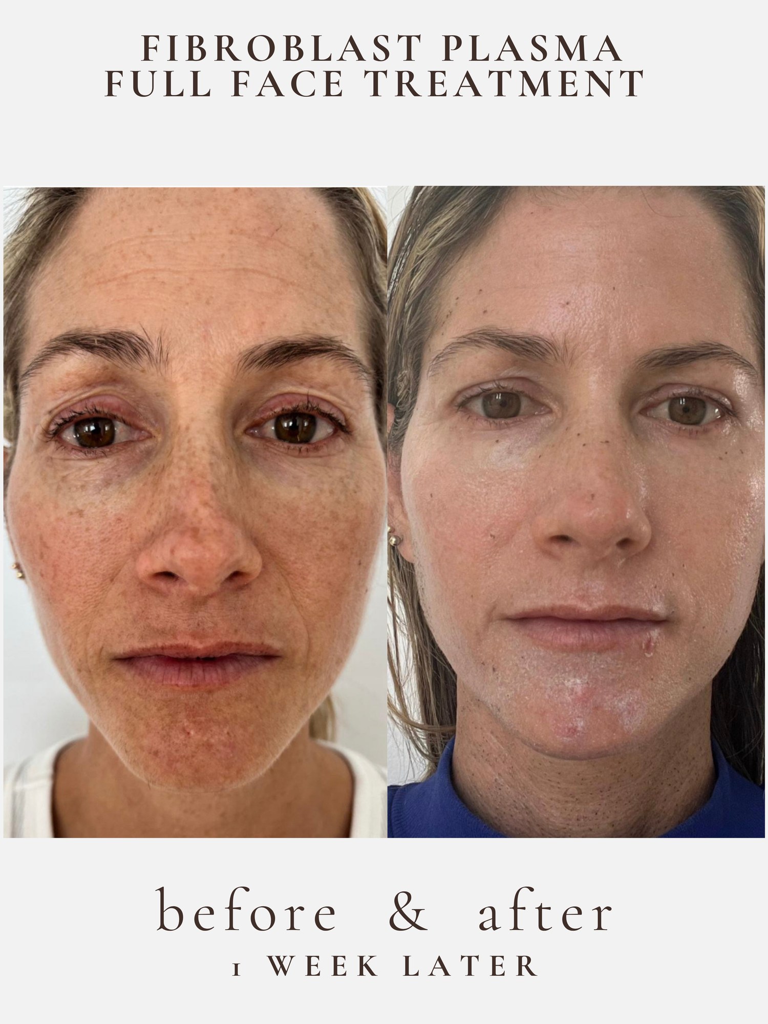 Full Face — Fibroblast Plasma