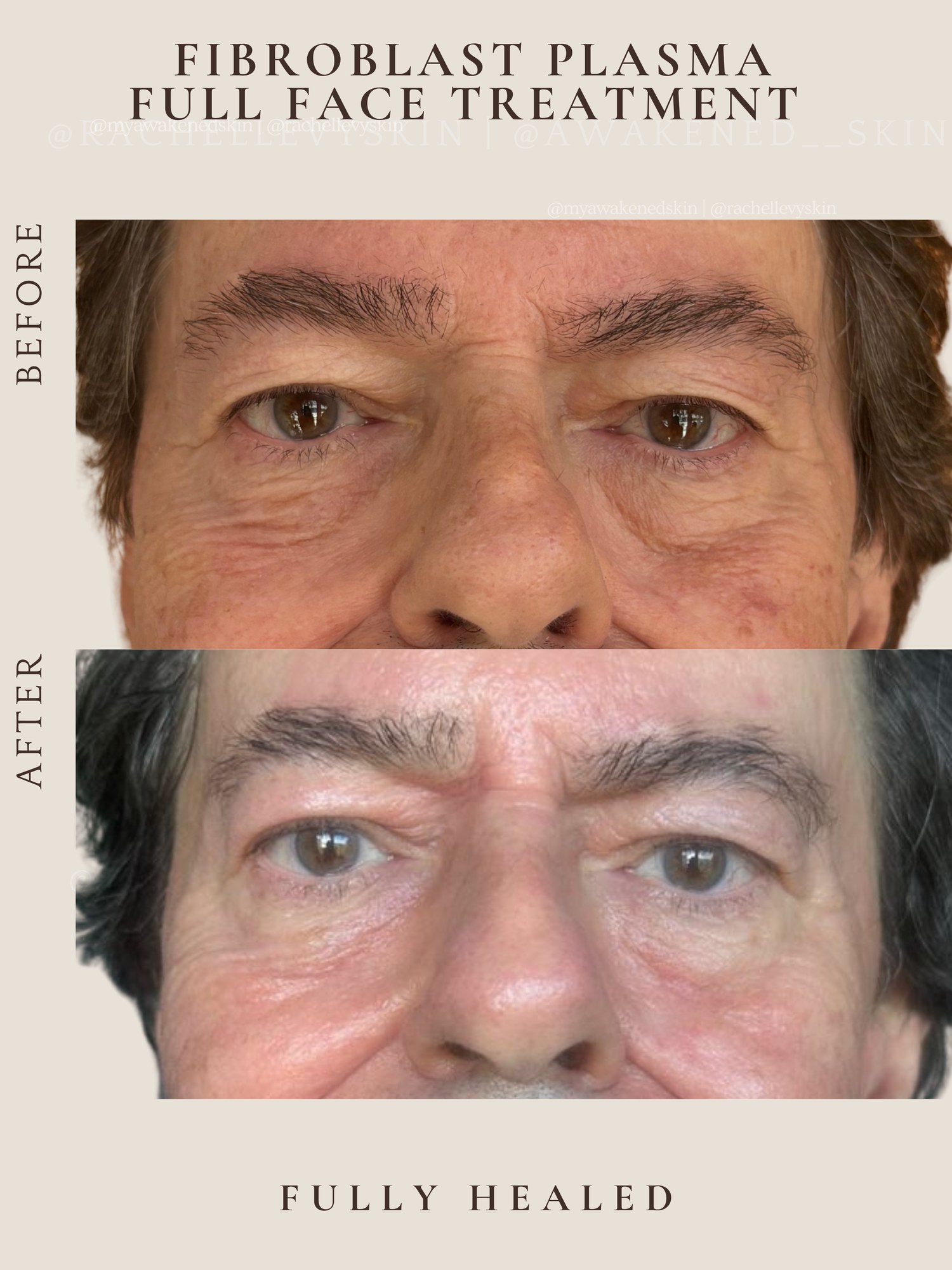 Full Face — Fibroblast Plasma