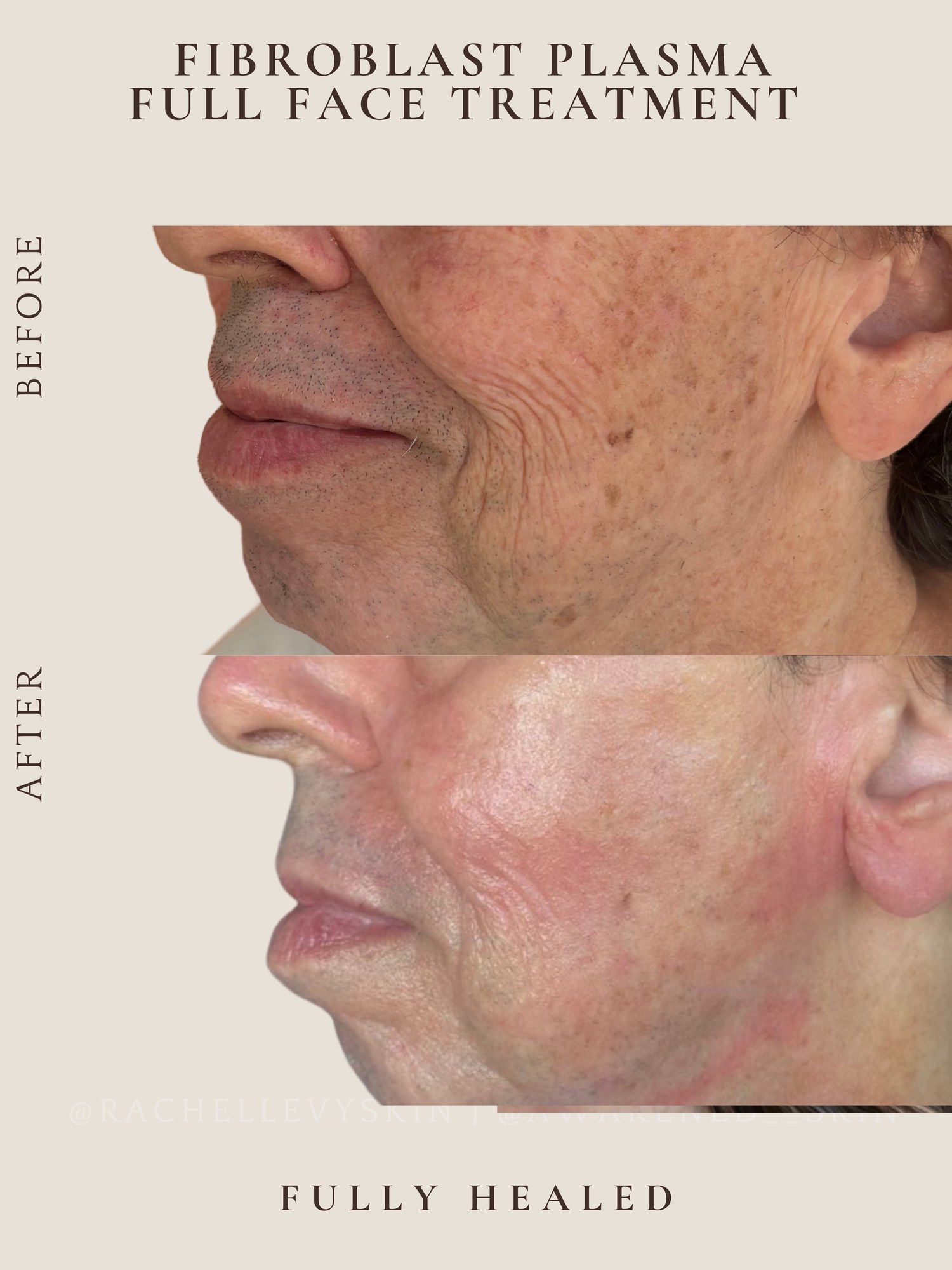 Full Face — Fibroblast Plasma