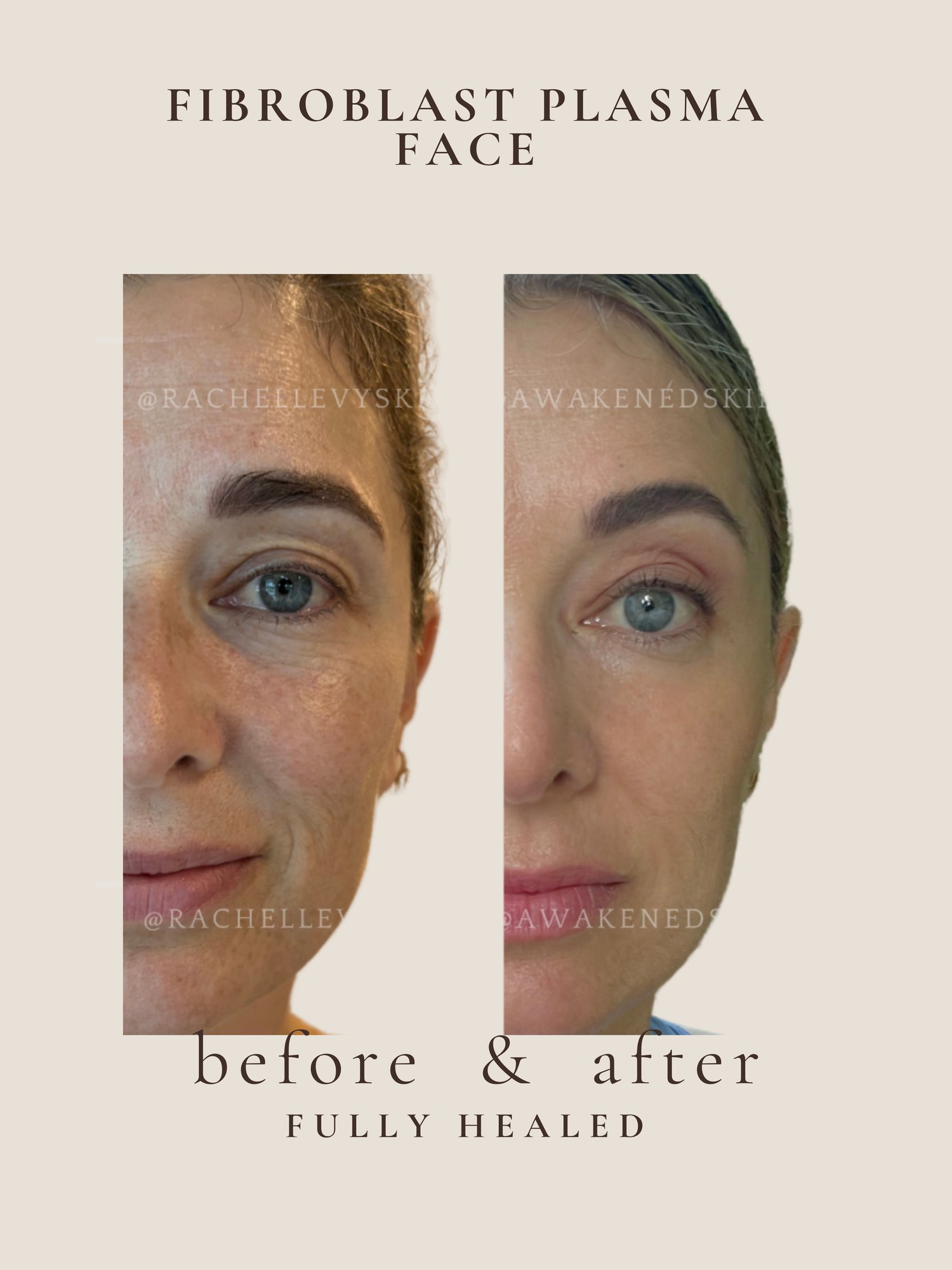 Full Face — Fibroblast Plasma