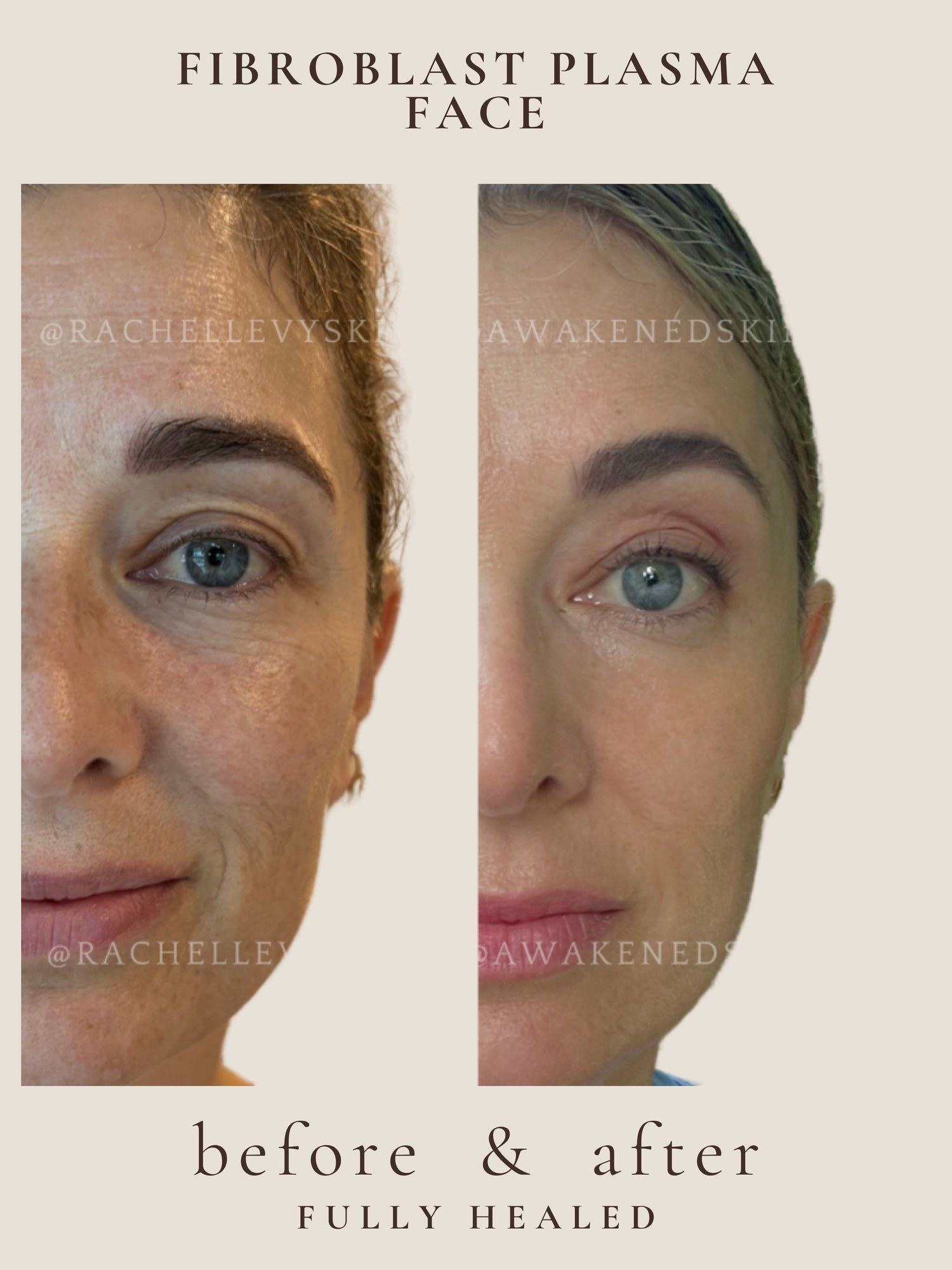 Full Face — Fibroblast Plasma
