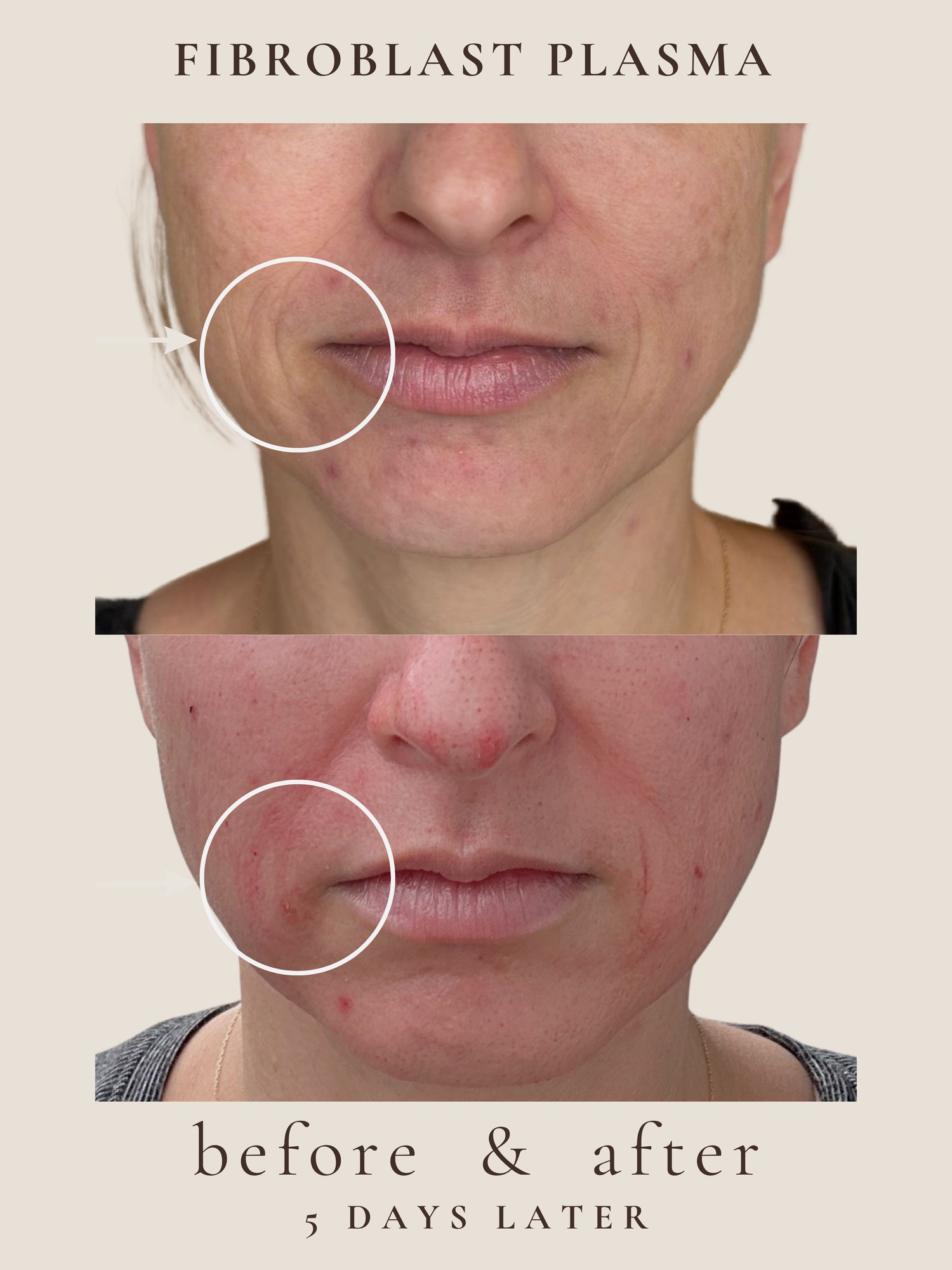 Full Face — Male — Fibroblast Plasma