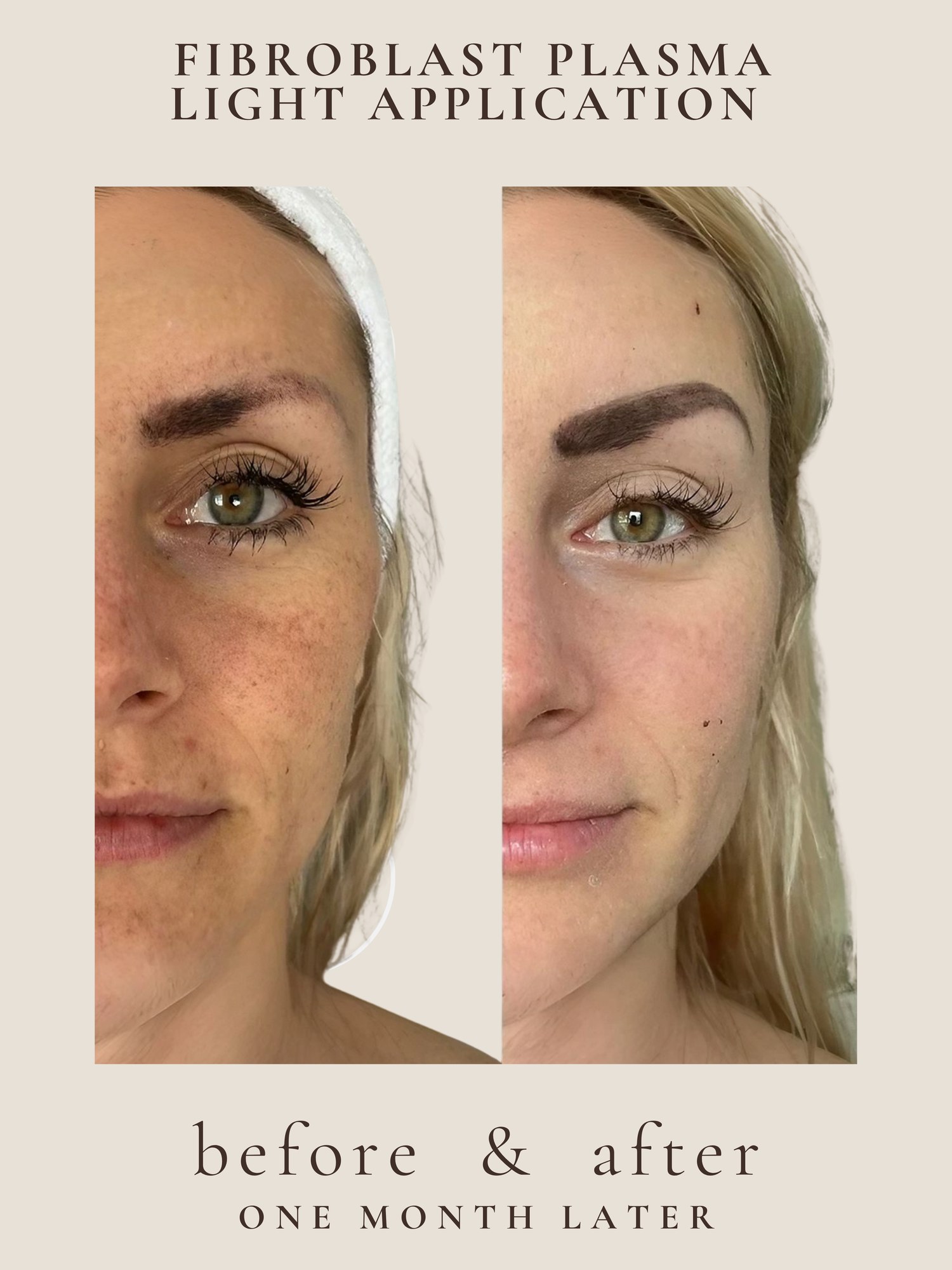 Full Face — Male — Fibroblast Plasma