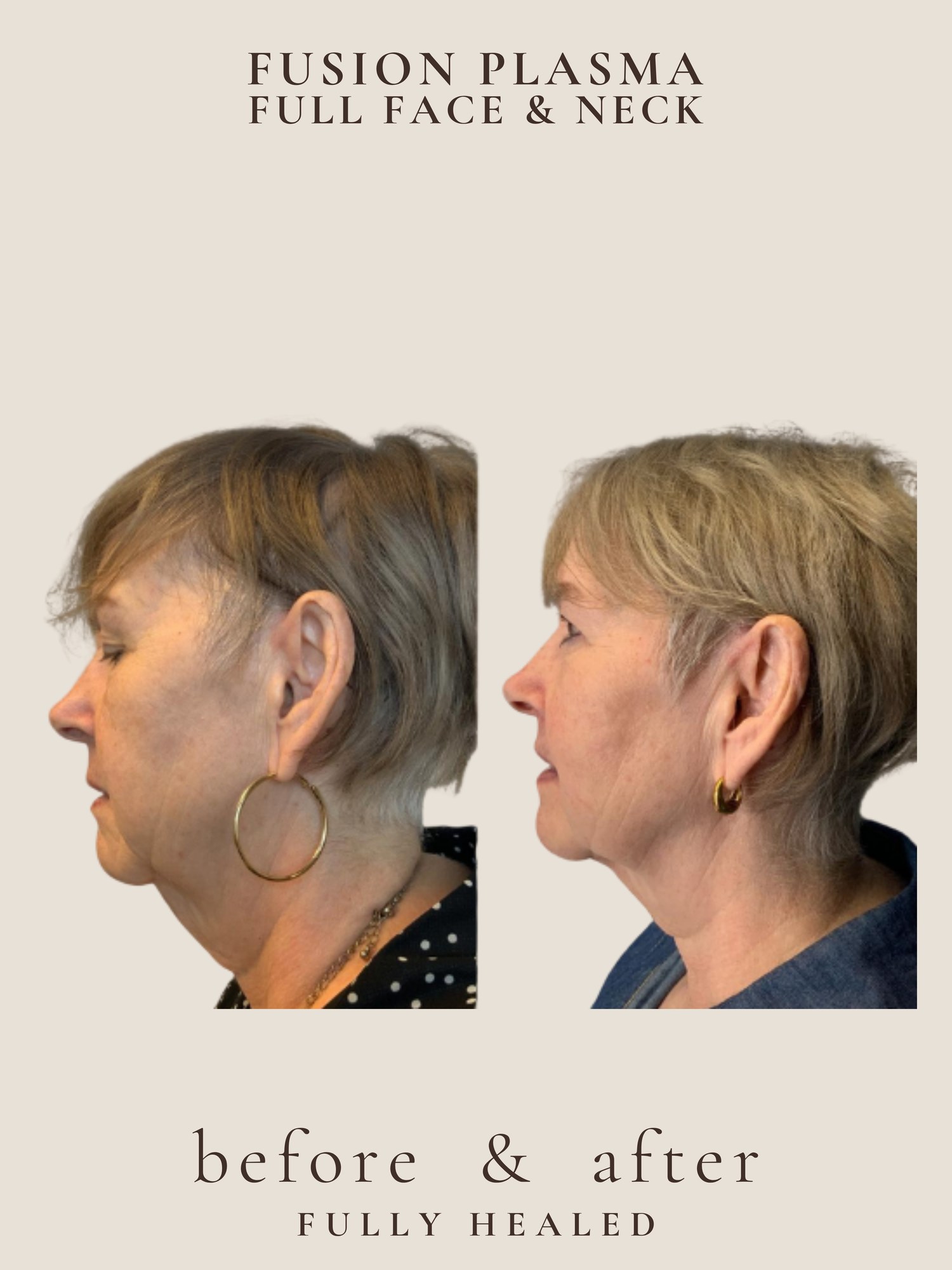 Face and neck lift before and after