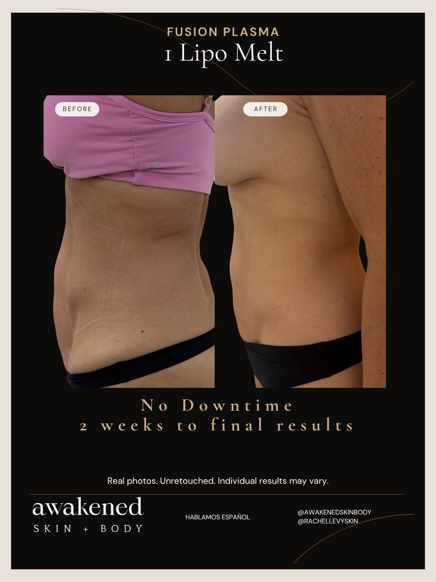 Lipo Melt before and after, Fusion Plasma