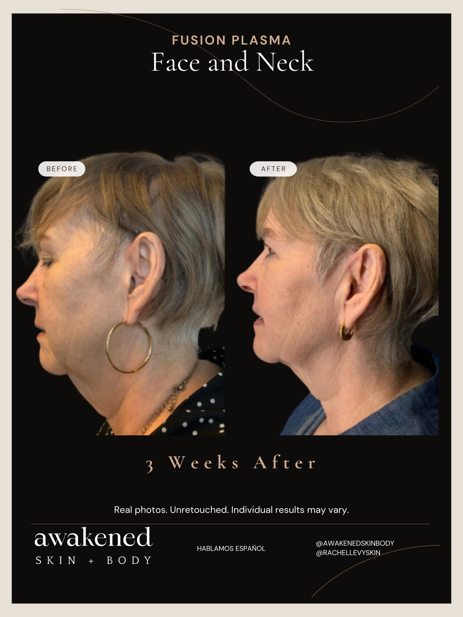 Face & Neck before and after, Fusion Plasma