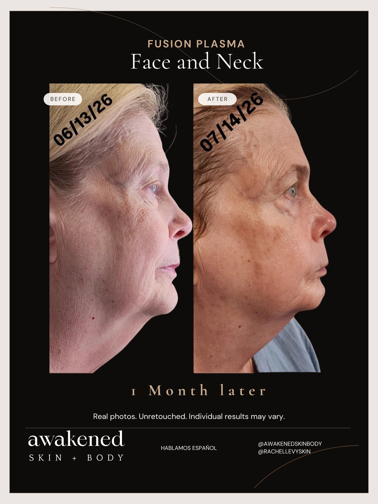 Face & Neck before and after, Fusion Plasma