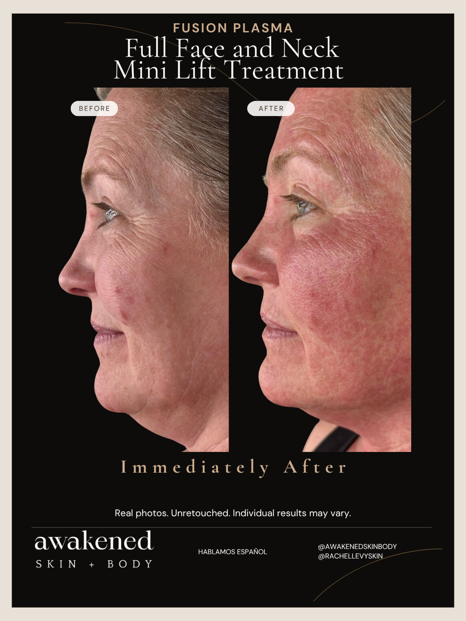 Face and neck mini lift before and after, Fusion Plasma