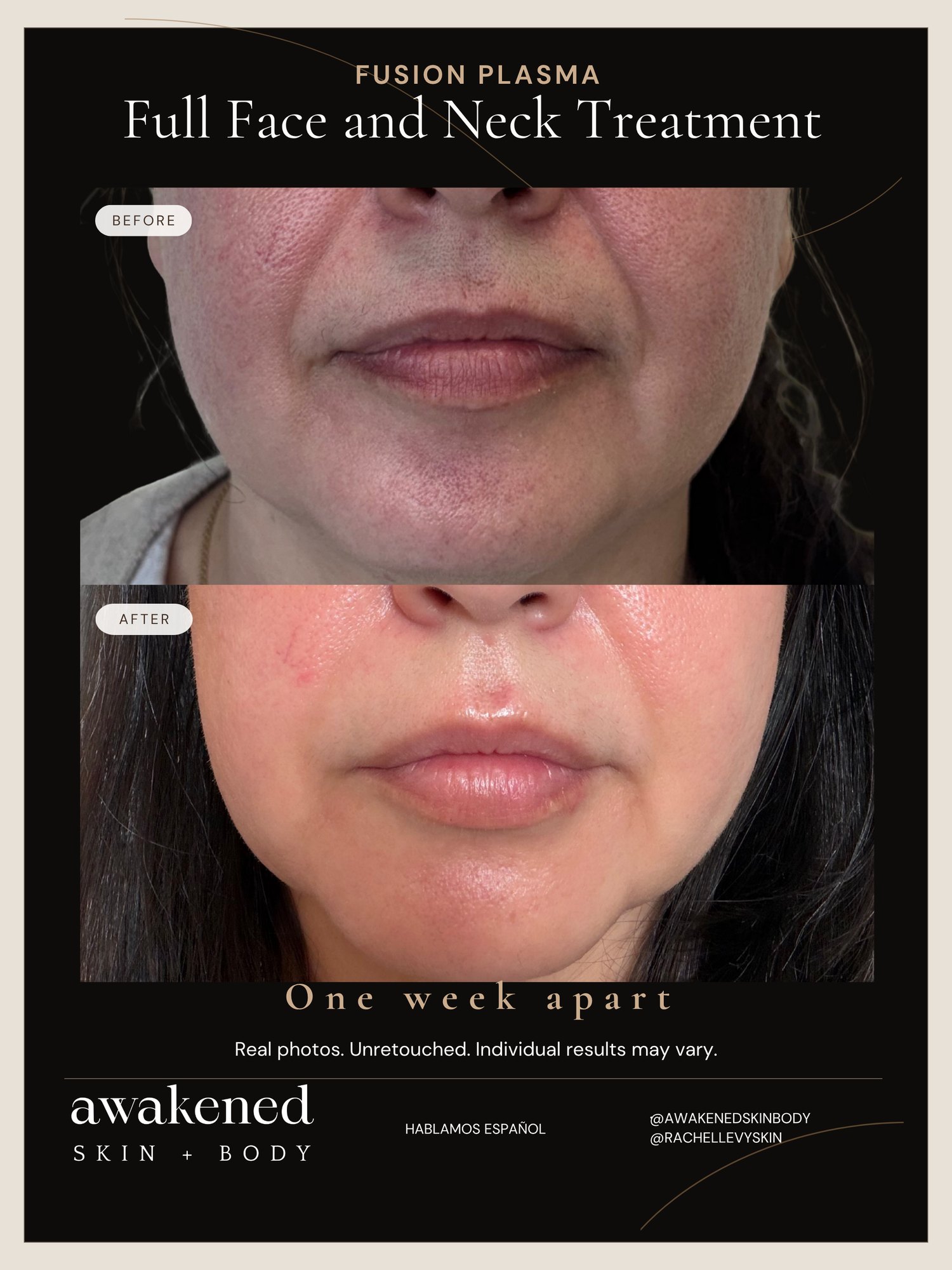 Face & Neck before and after, Fusion Plasma