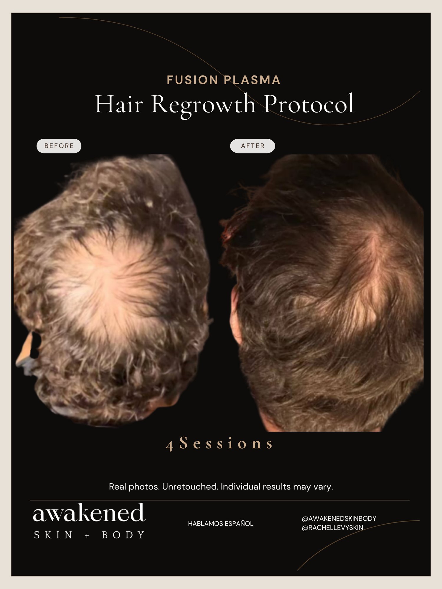 Hair density restored before and after