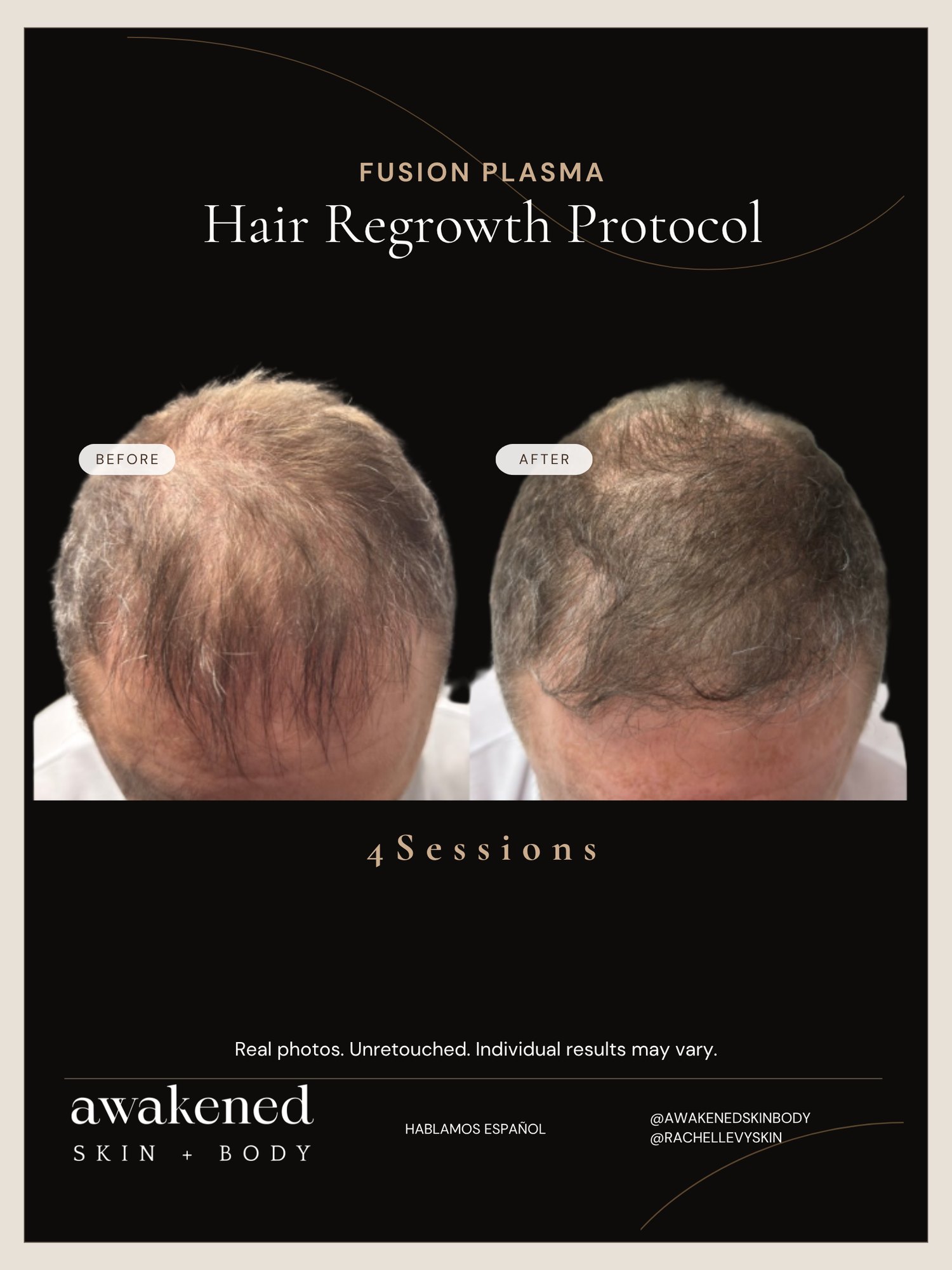 Hair Regrowth before and after, Fusion Plasma
