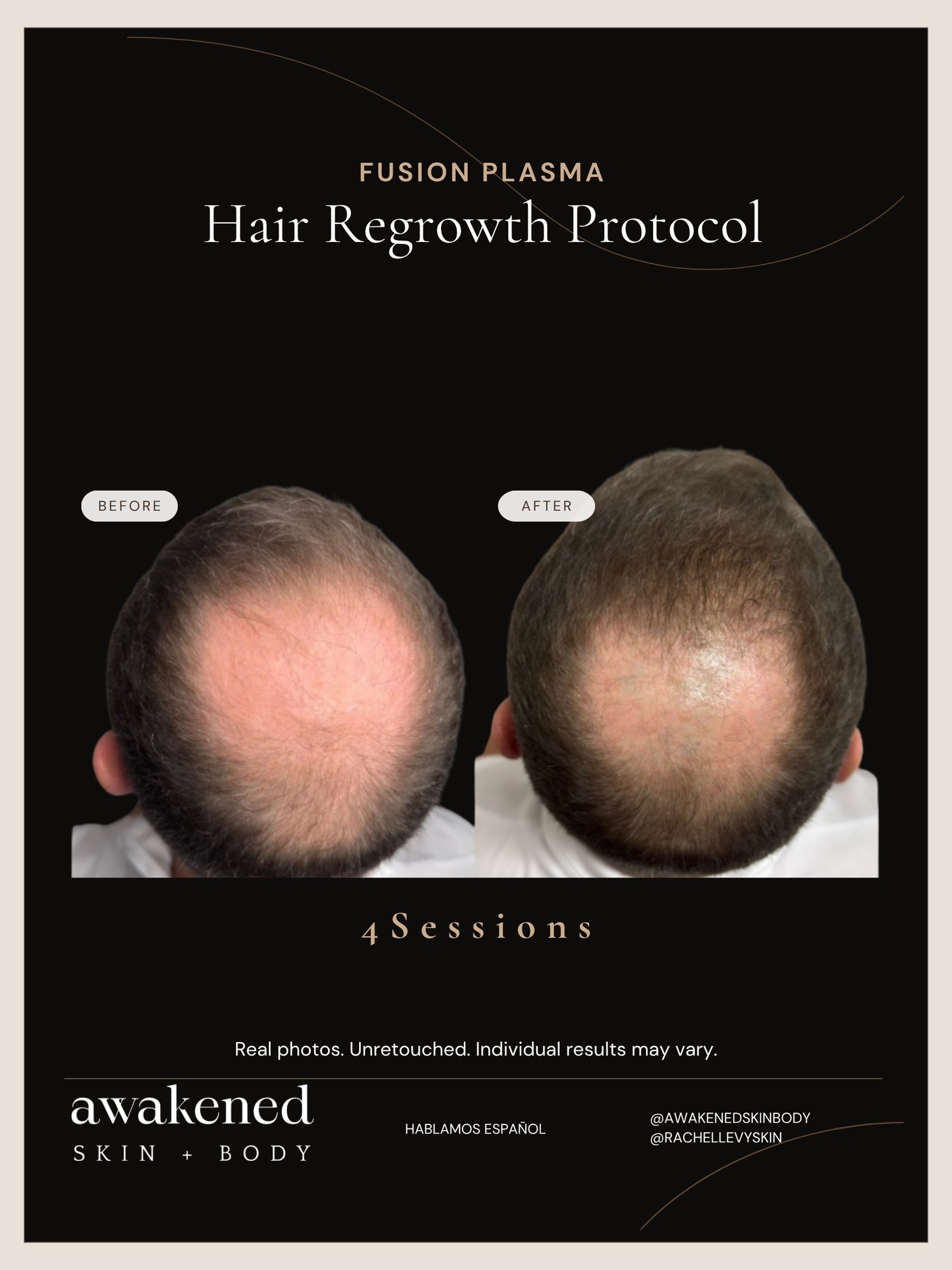 Hair Regrowth before and after, Fusion Plasma