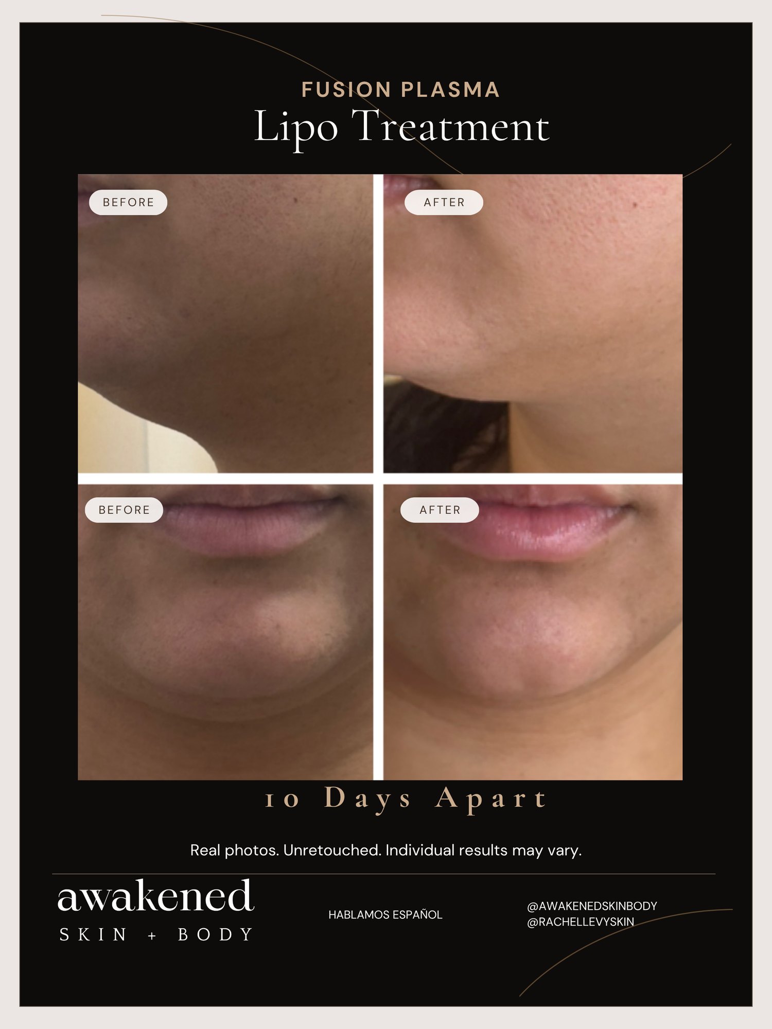 Lipo Contour before and after, Fusion Plasma