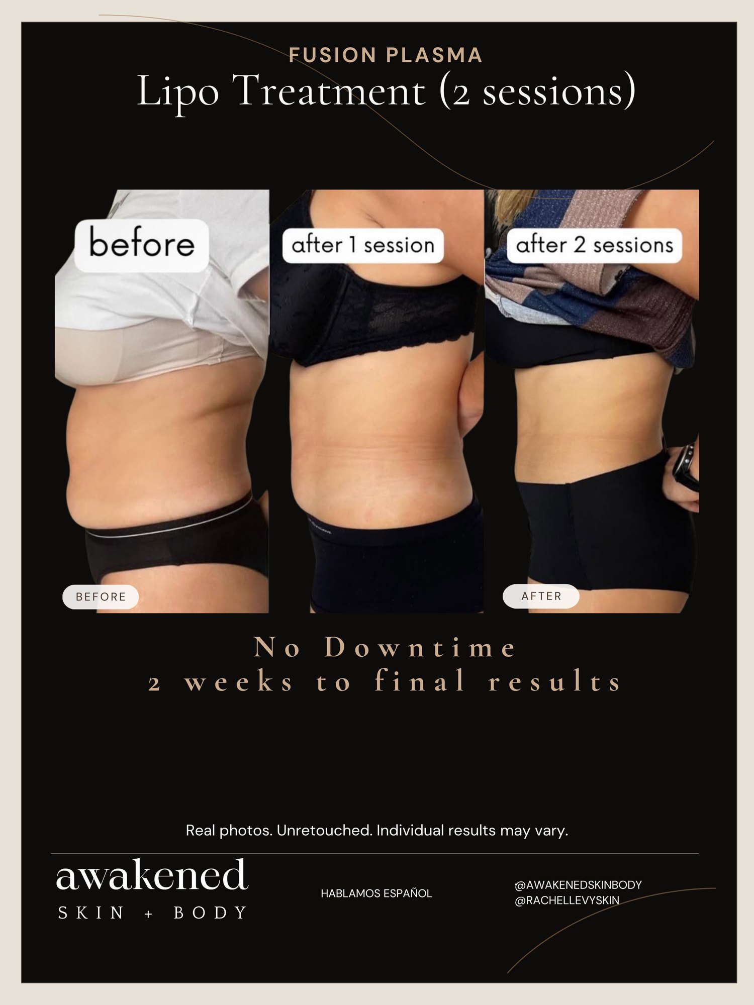 Lipo Contour before and after, Fusion Plasma