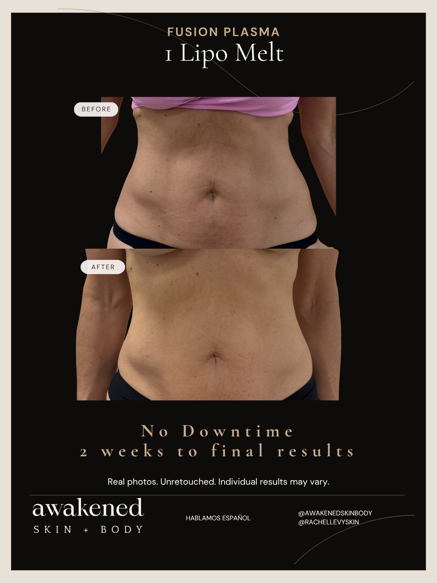 Lipo Melt before and after, Fusion Plasma