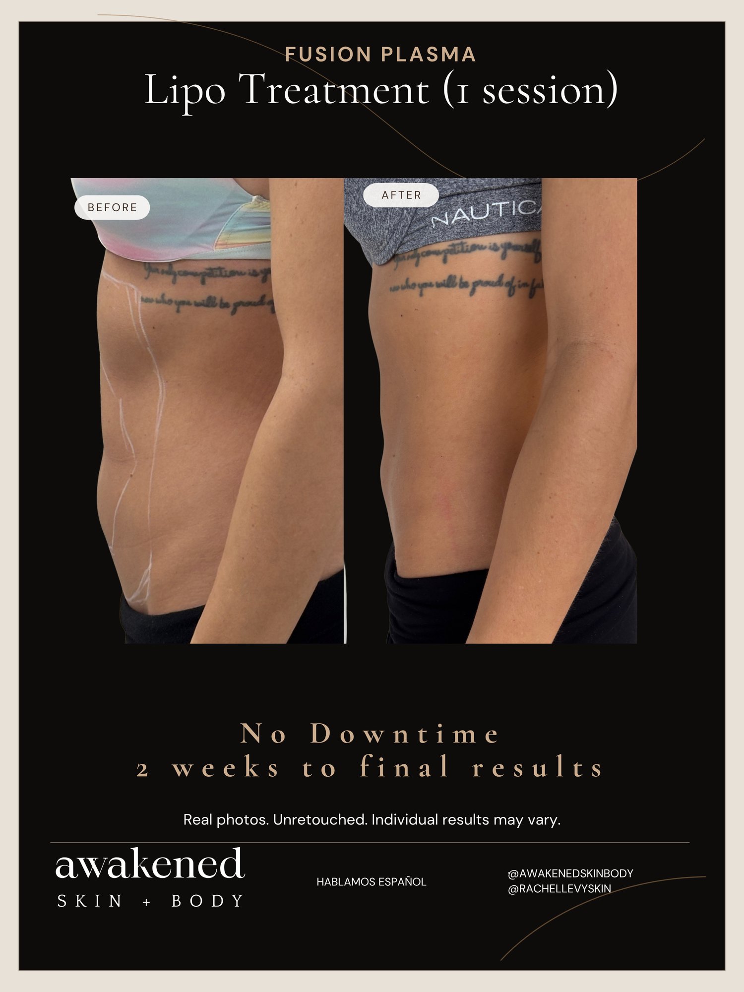 Lipo Contour before and after, Fusion Plasma