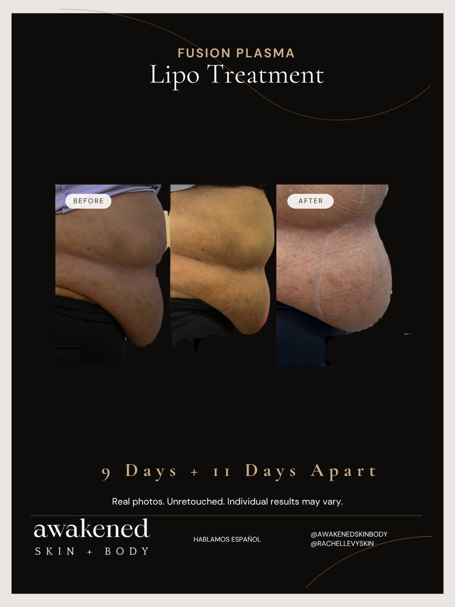 Lipo Contour before and after, Fusion Plasma