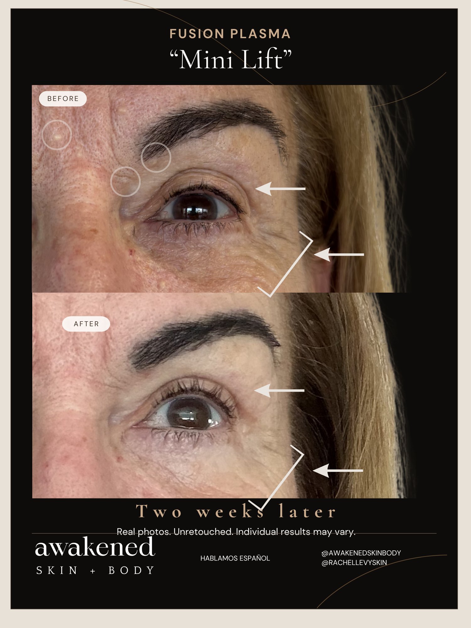Mini lift with Fusion Plasma, before and after