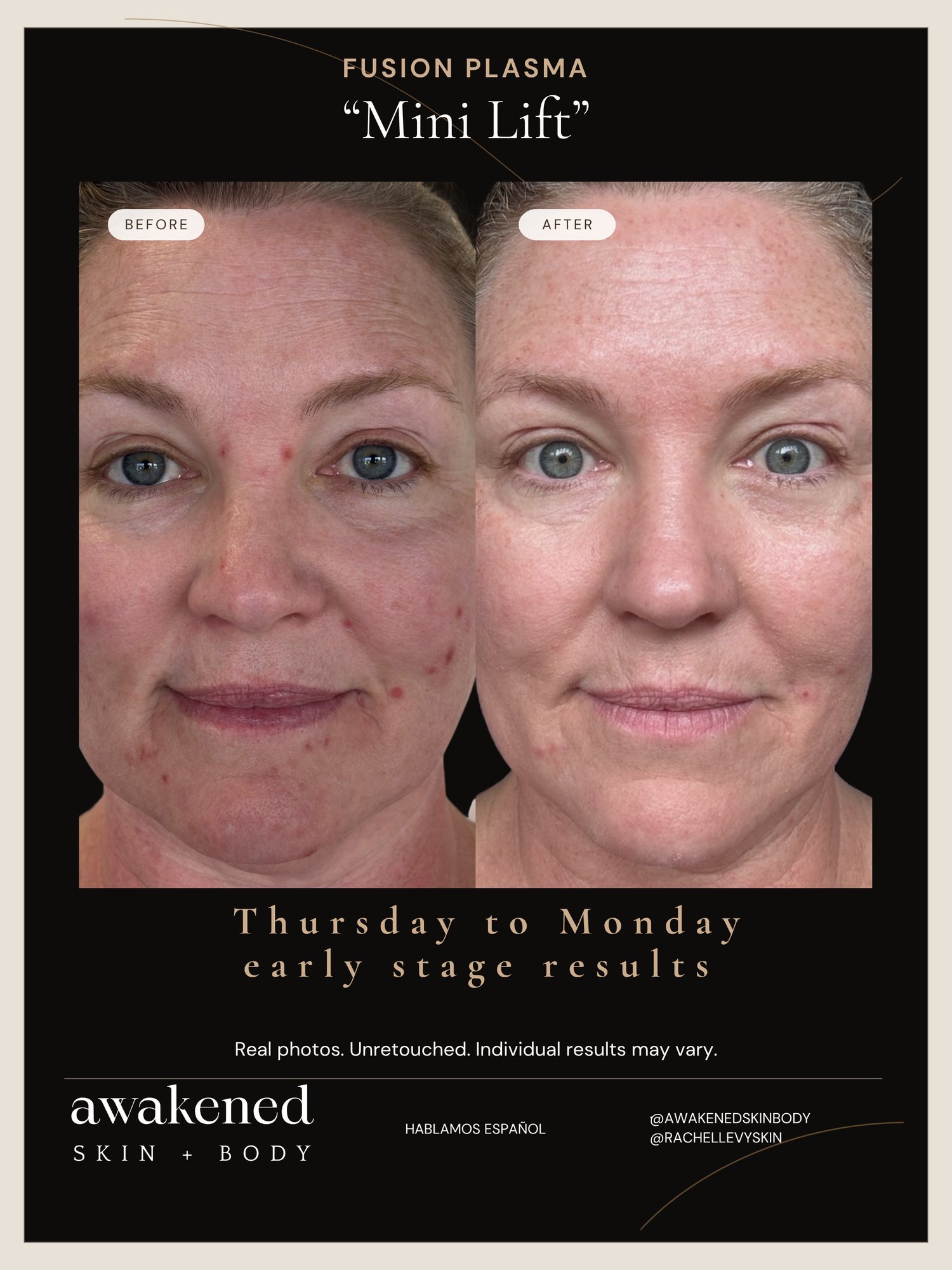 Mini Lift before and after, Fusion Plasma
