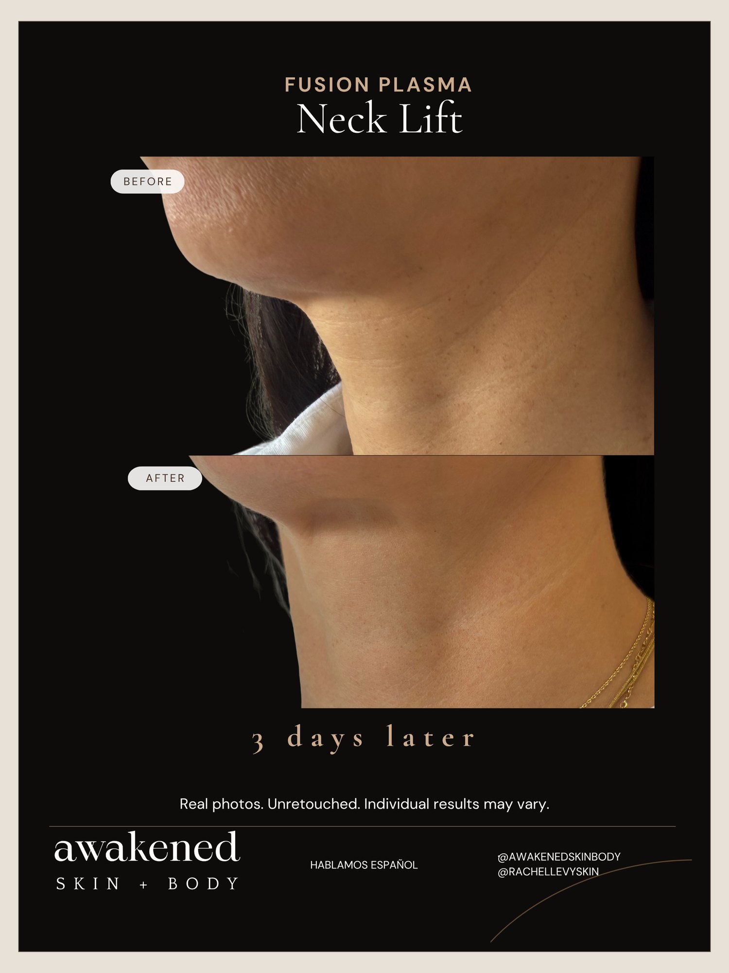Neck before and after, Fusion Plasma