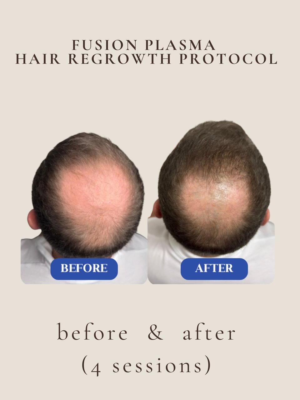 Hair density restored before and after