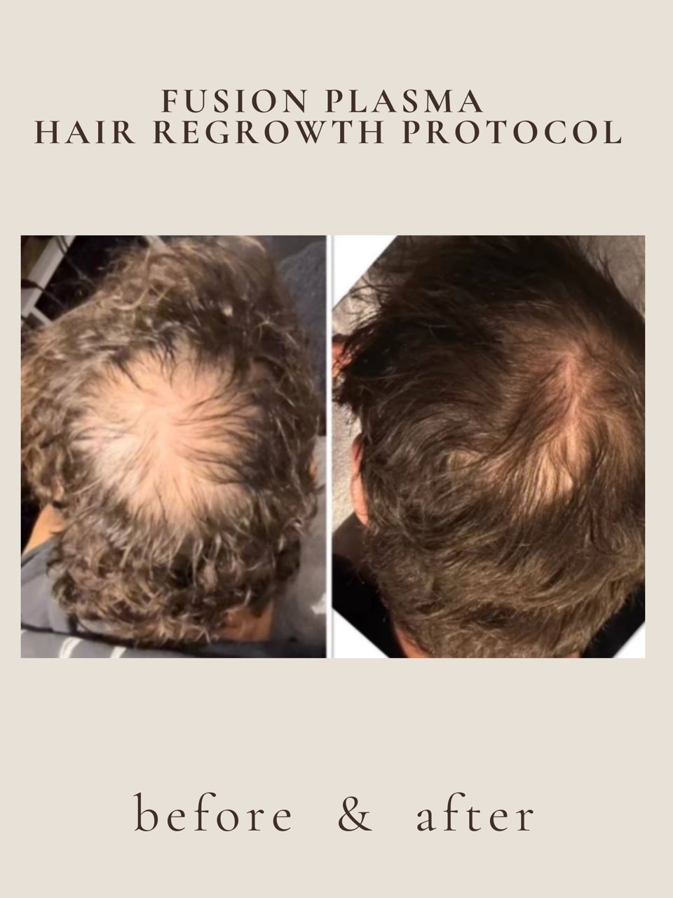 Crown Coverage — Fusion Plasma · 4 sessions