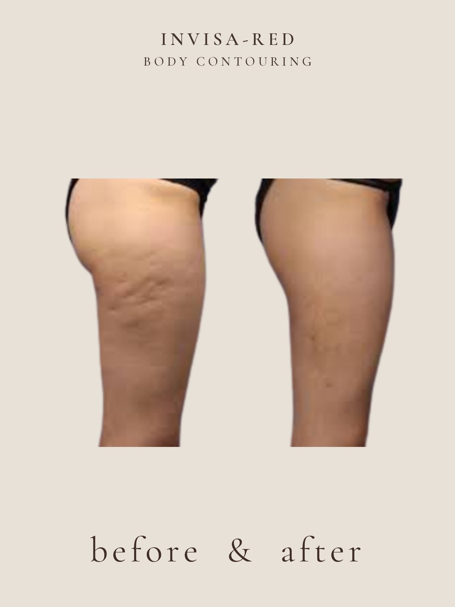 Cellulite — Invisa-RED® Aesthetics