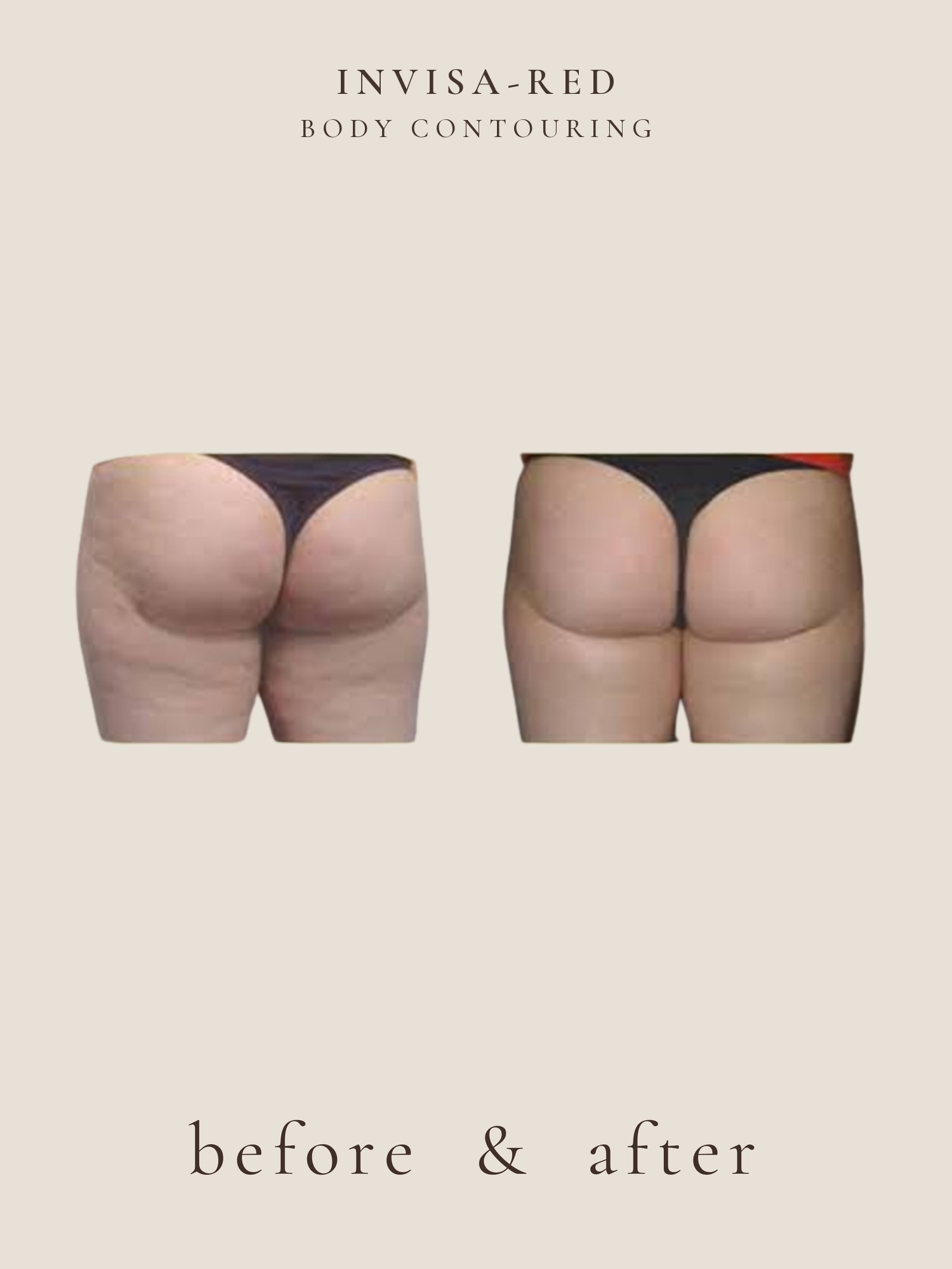 Cellulite — Invisa-RED® Aesthetics