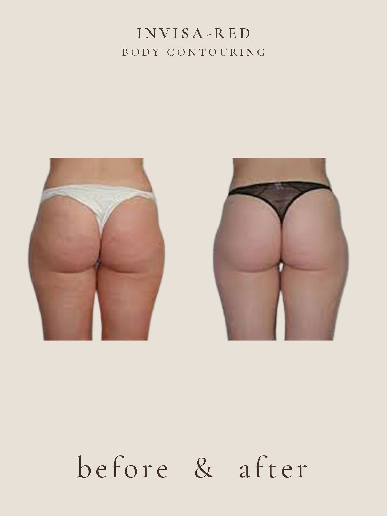 Cellulite — Invisa-RED® Aesthetics
