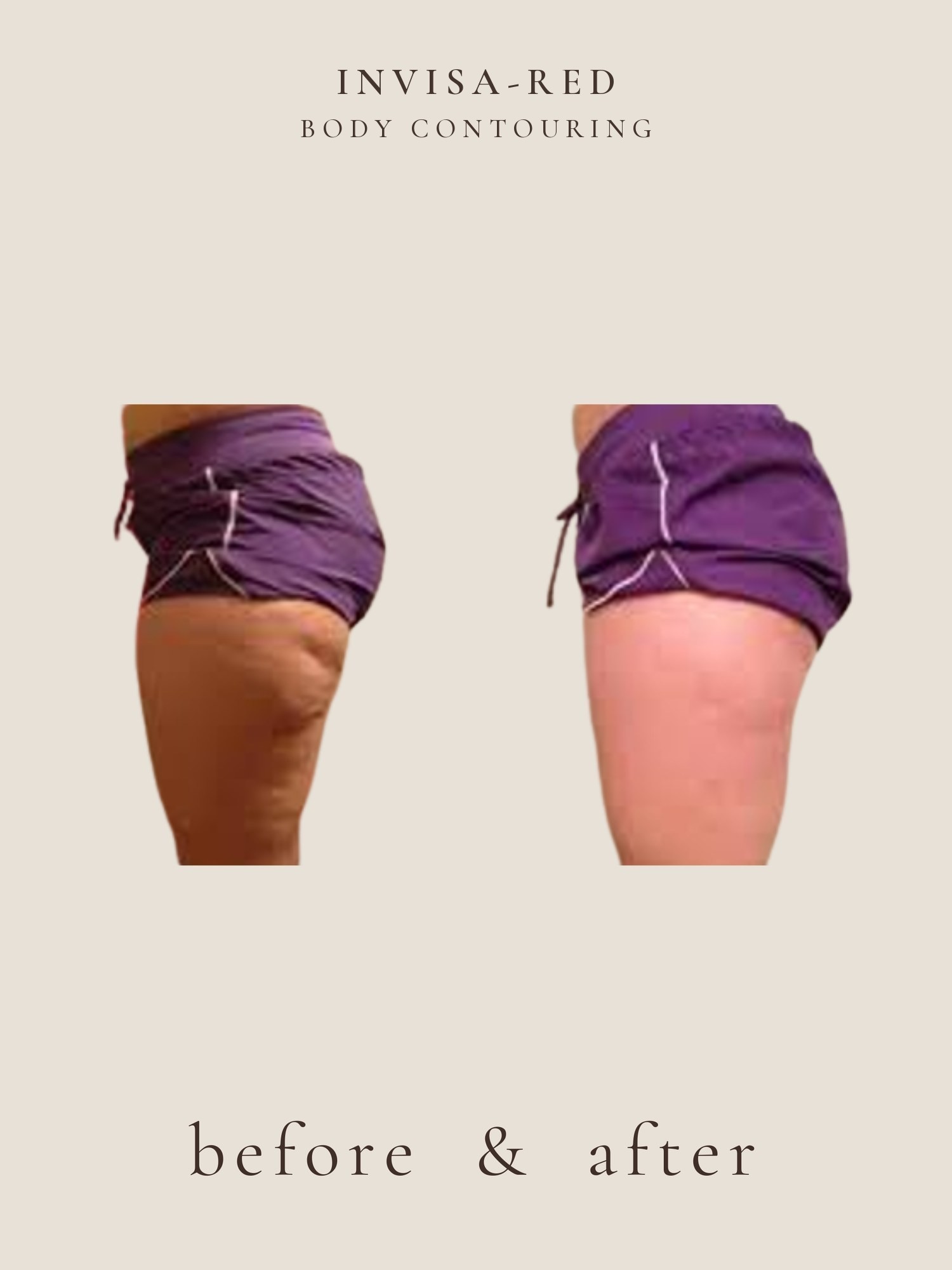 Cellulite — Invisa-RED® Aesthetics