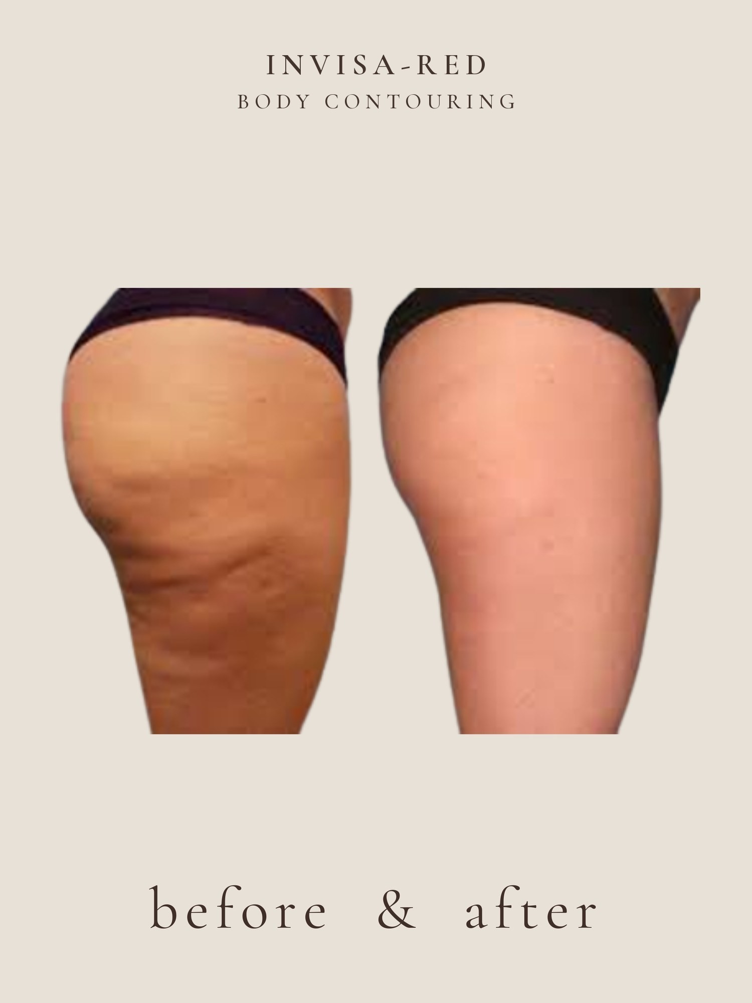 Cellulite — Invisa-RED® Aesthetics