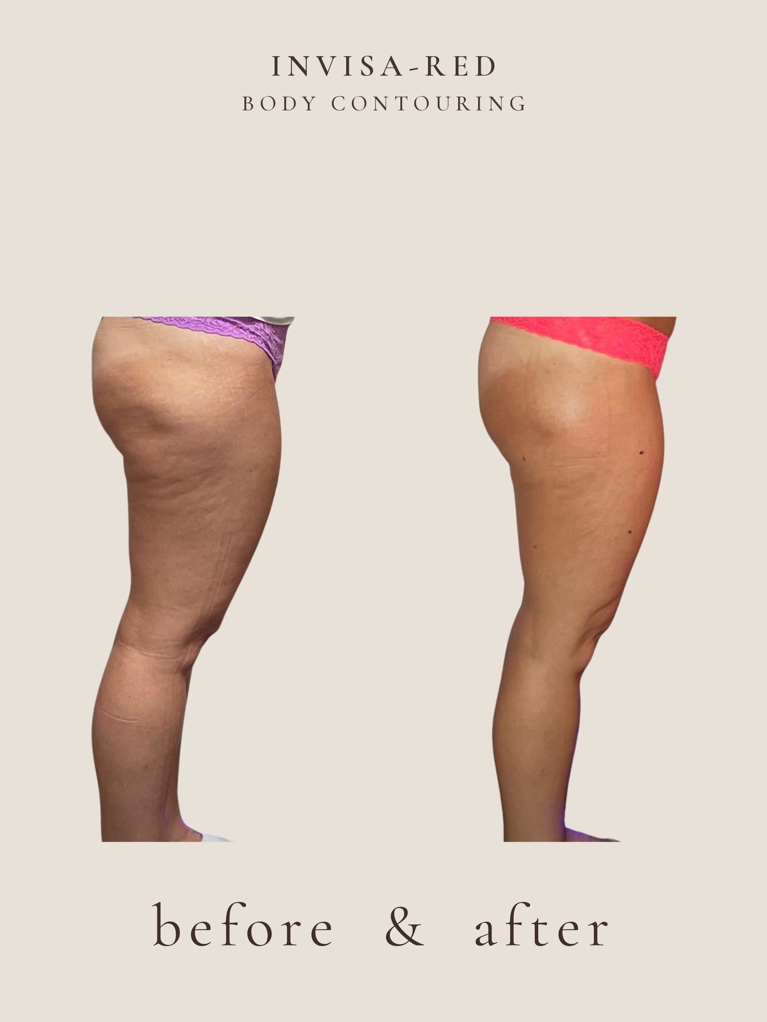 Body Contouring — Invisa-RED® Aesthetics