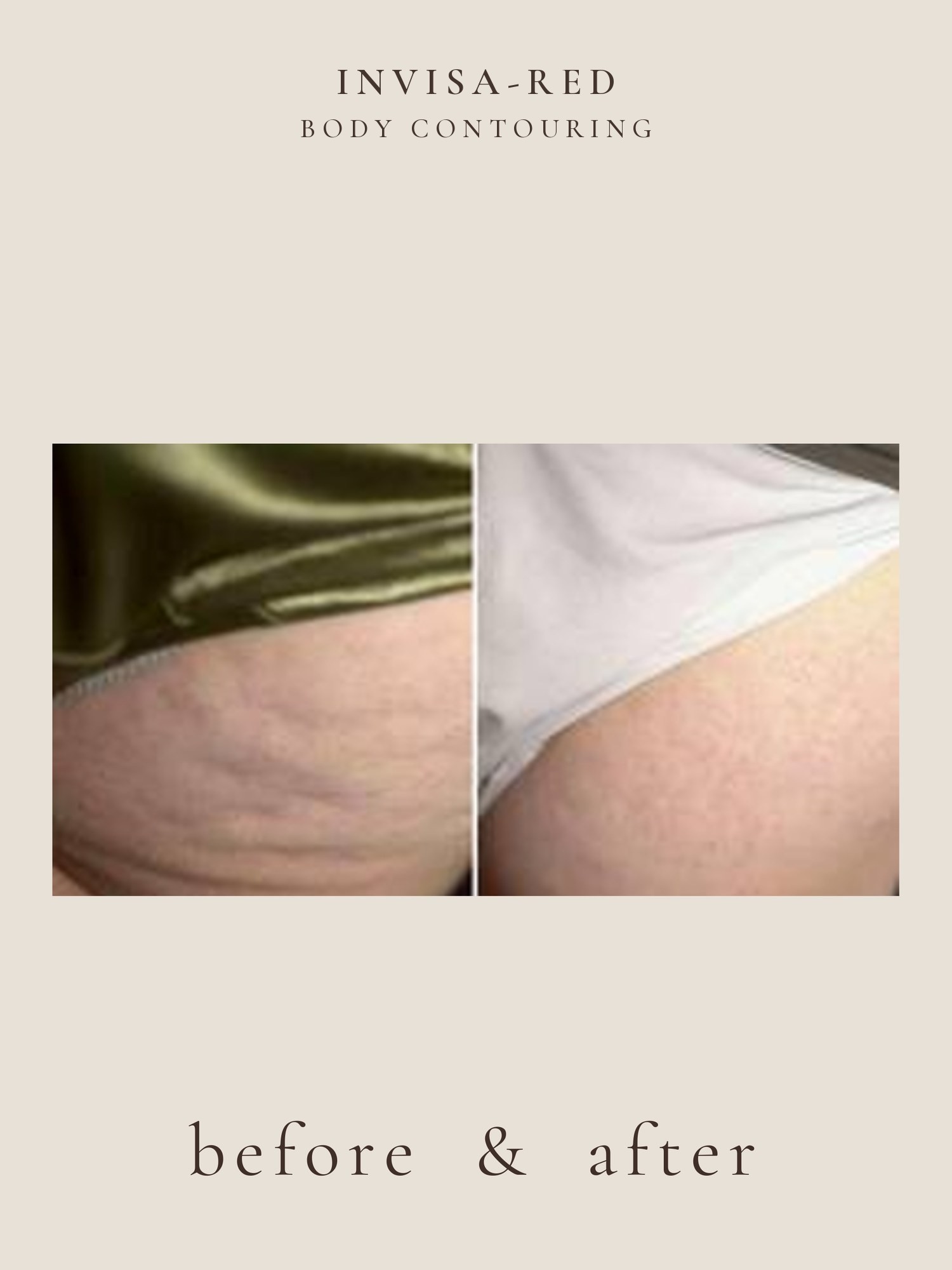 Body Contouring — Invisa-RED® Aesthetics