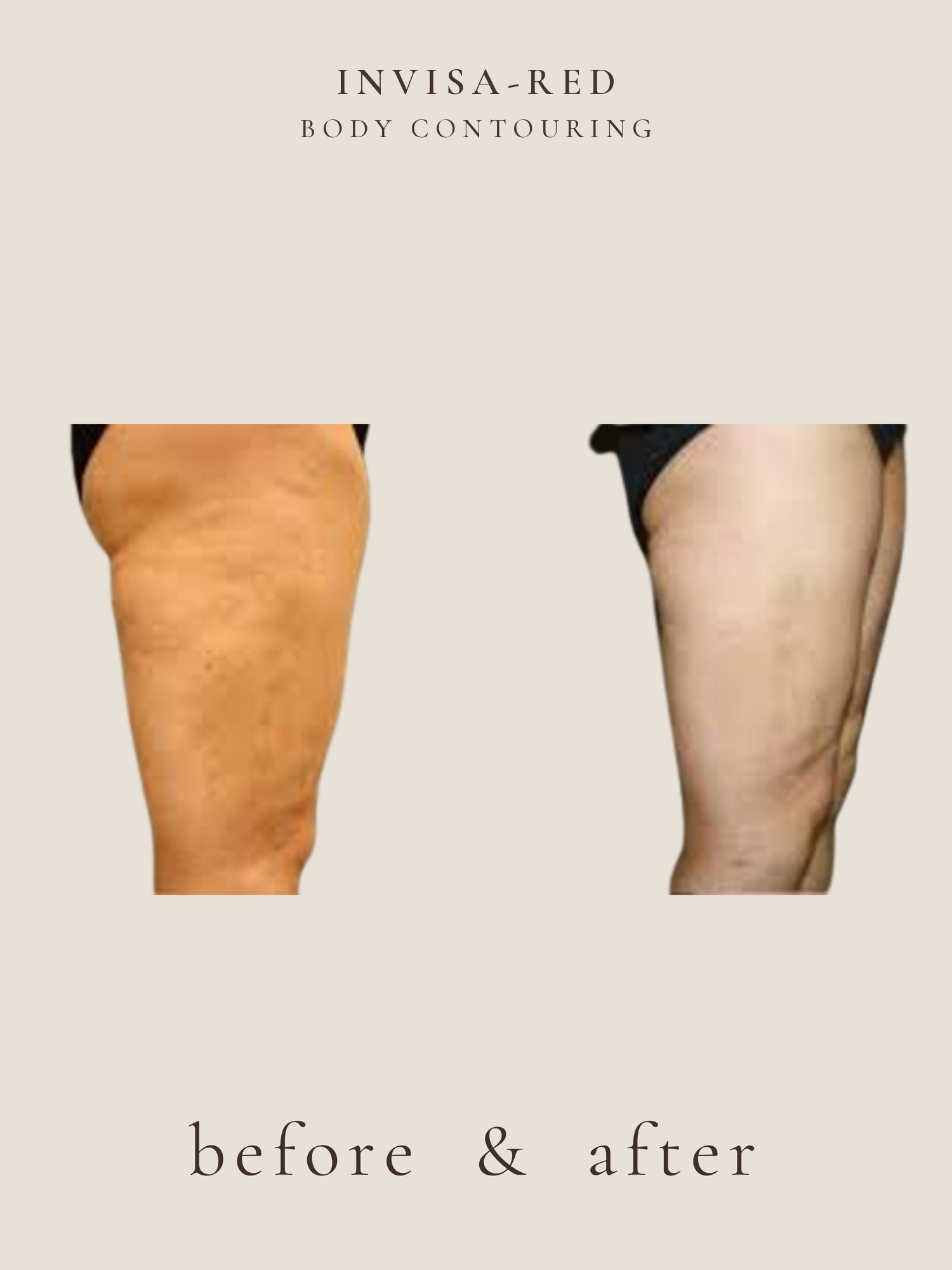 Body Contouring — Invisa-RED® Aesthetics