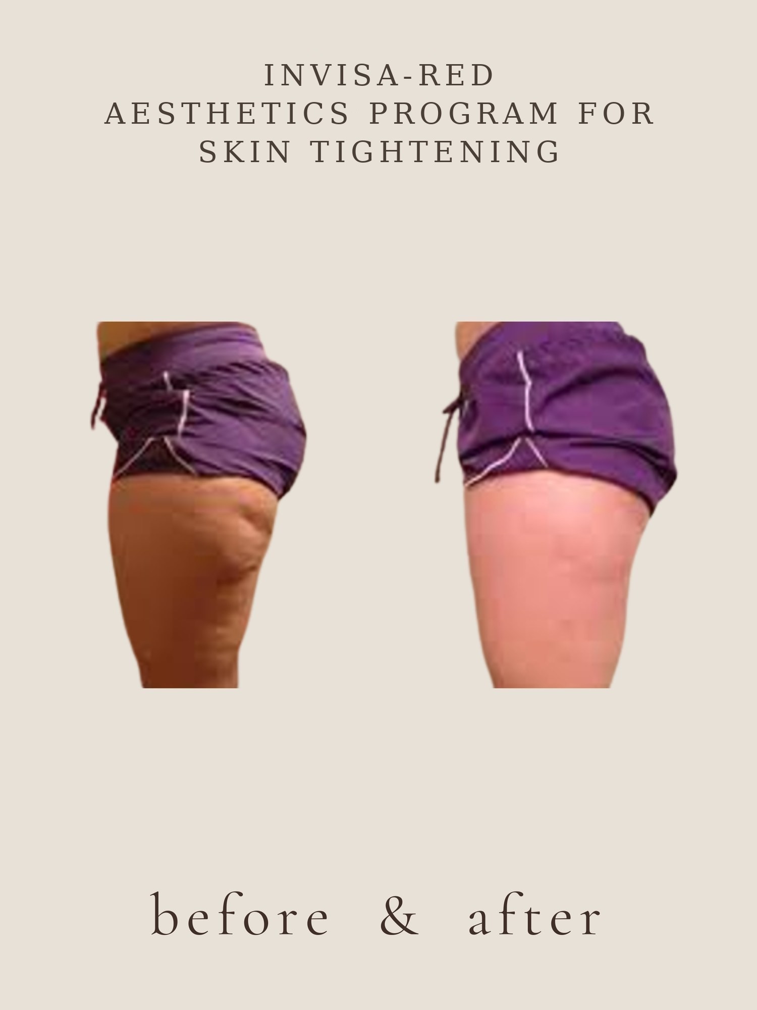 Body Contouring — Invisa-RED® Aesthetics