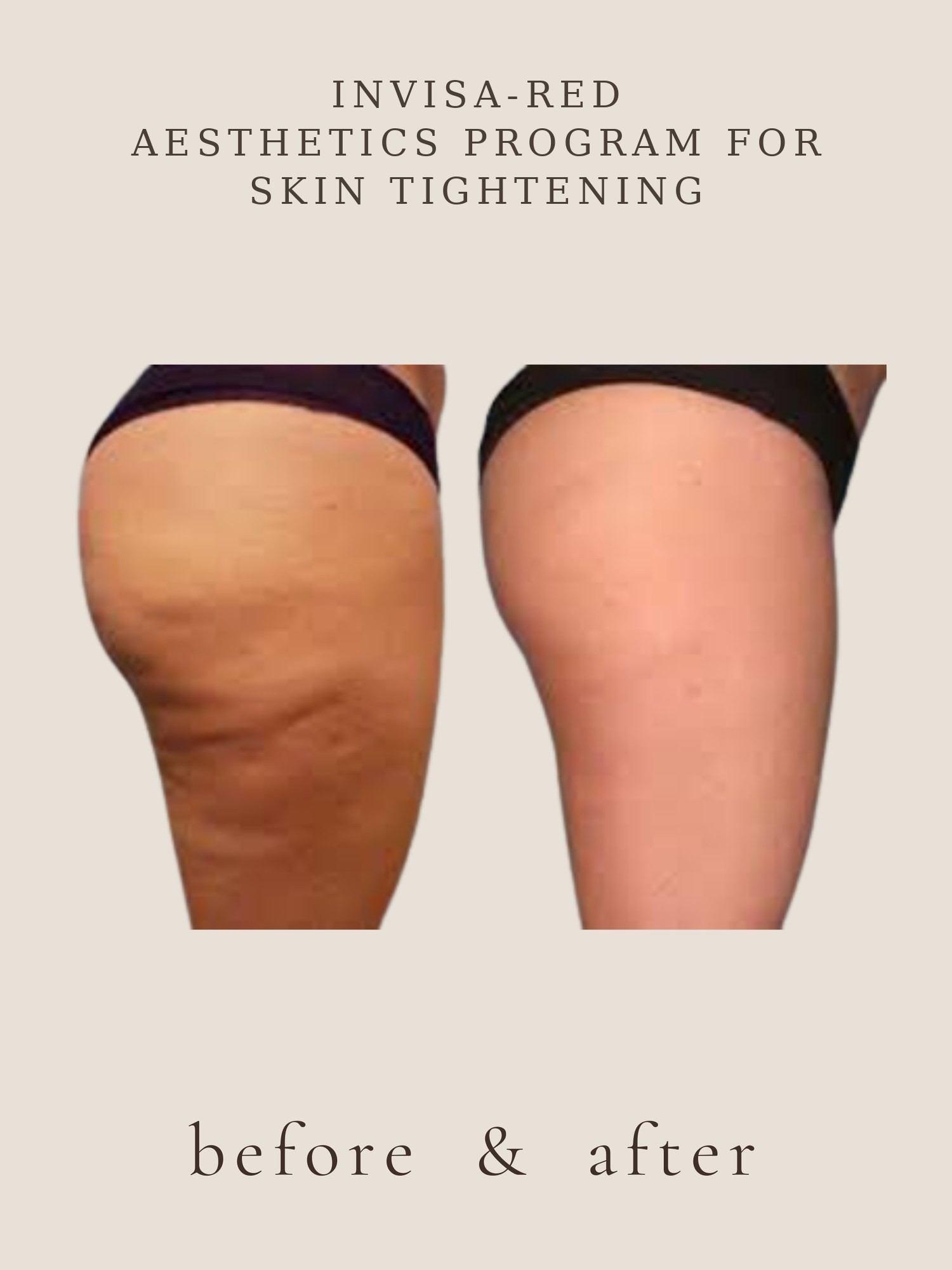 Body Contouring — Invisa-RED® Aesthetics